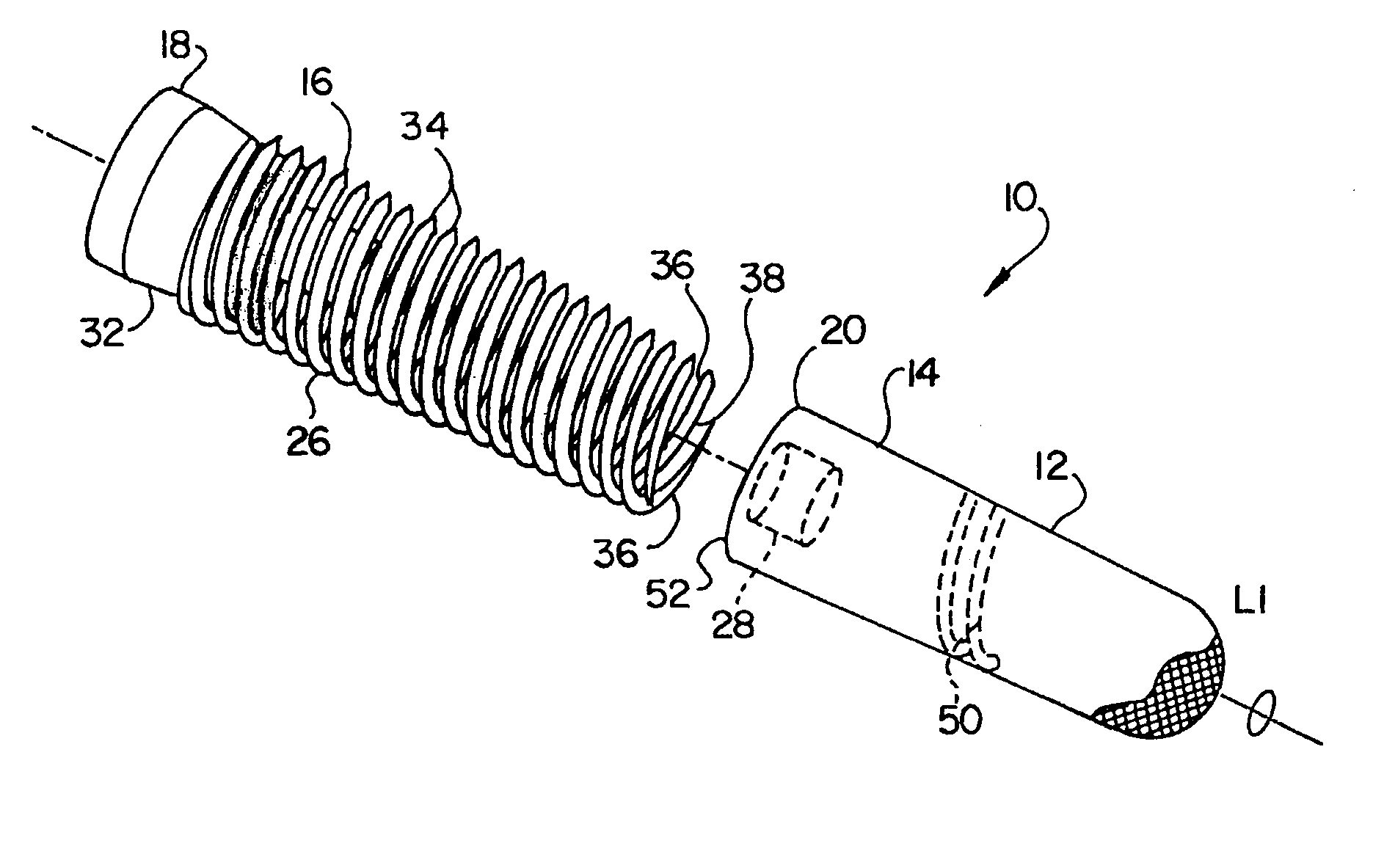 Porous implant with non-porous threads