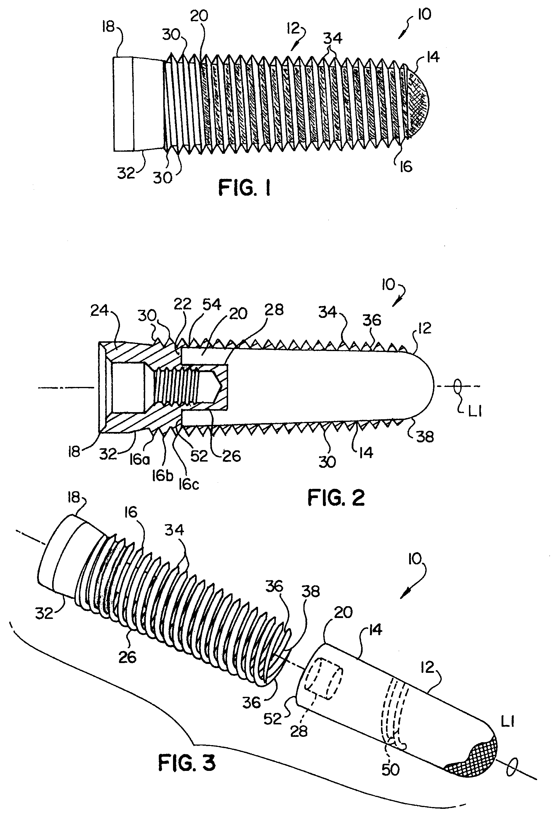 Porous implant with non-porous threads