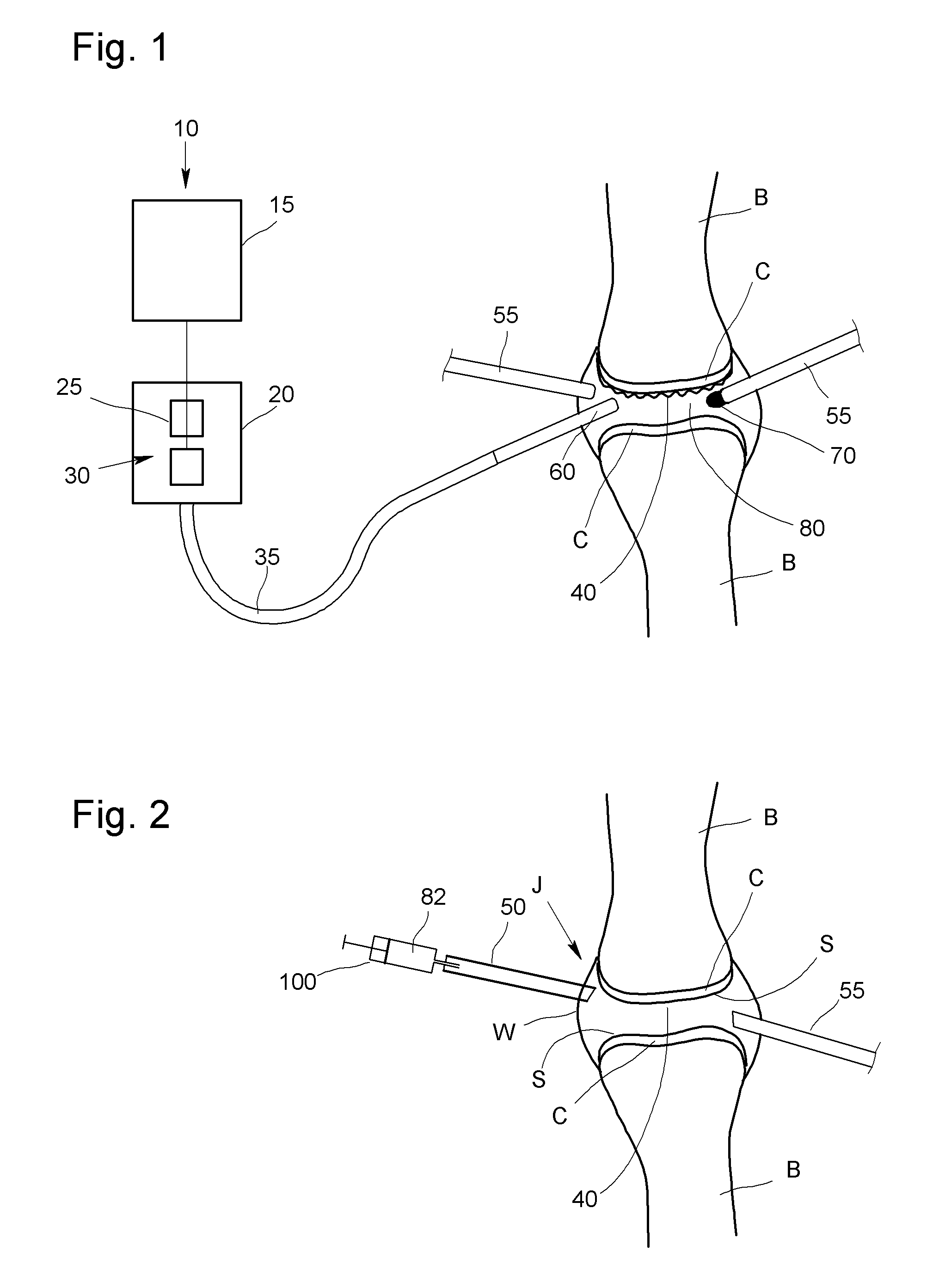Method for the ablation of cartilage tissue in a knee joint using indocyanine