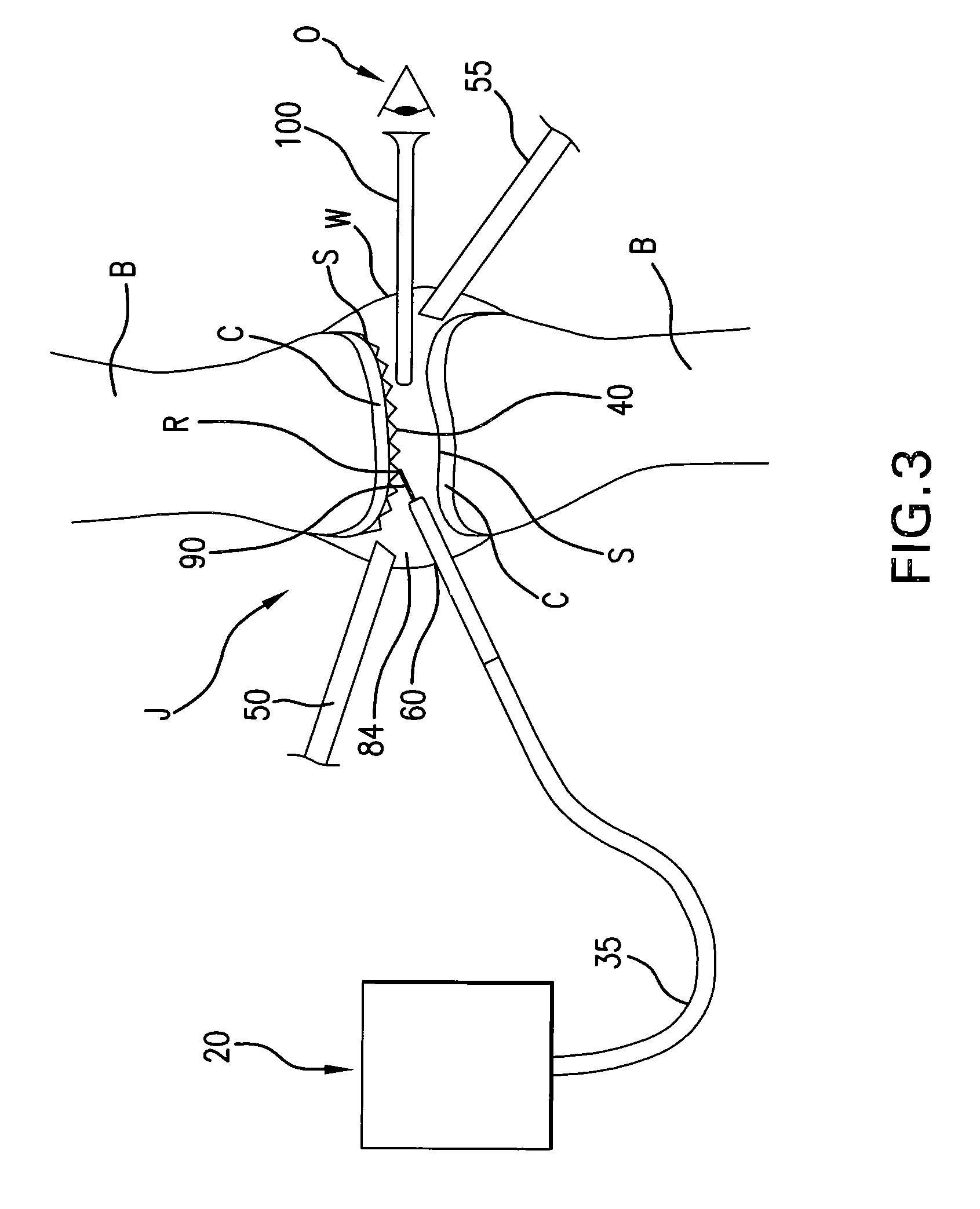 Method for the ablation of cartilage tissue in a knee joint using indocyanine