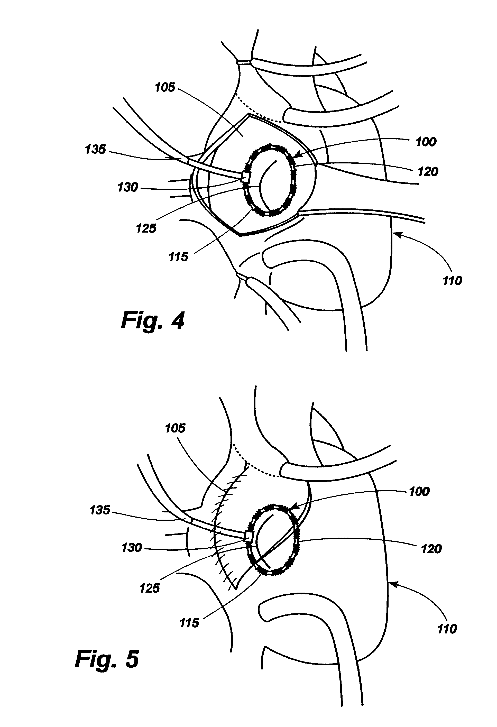 Magnetic docking system and method for the long term adjustment of an implantable device