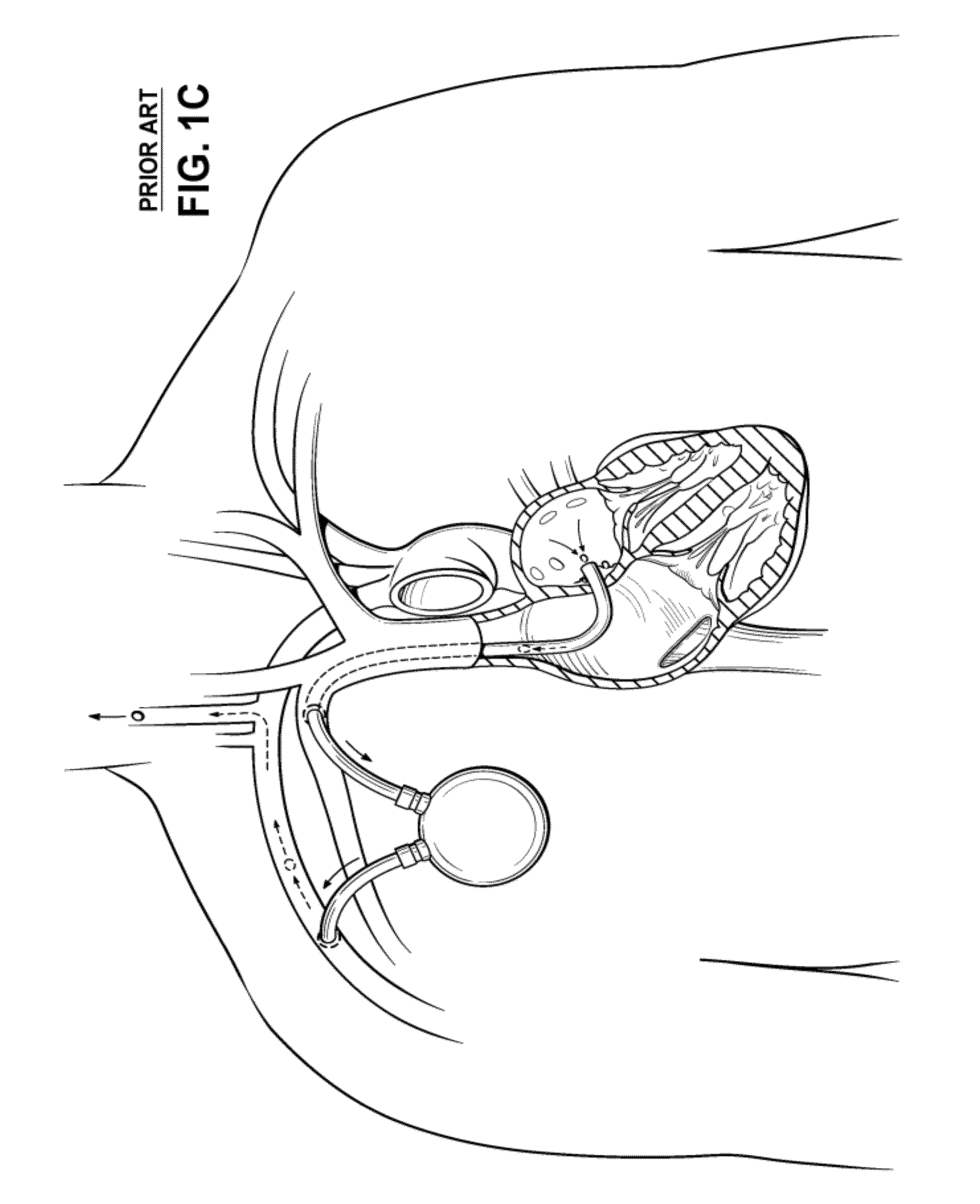 Cannula Systems and Methods