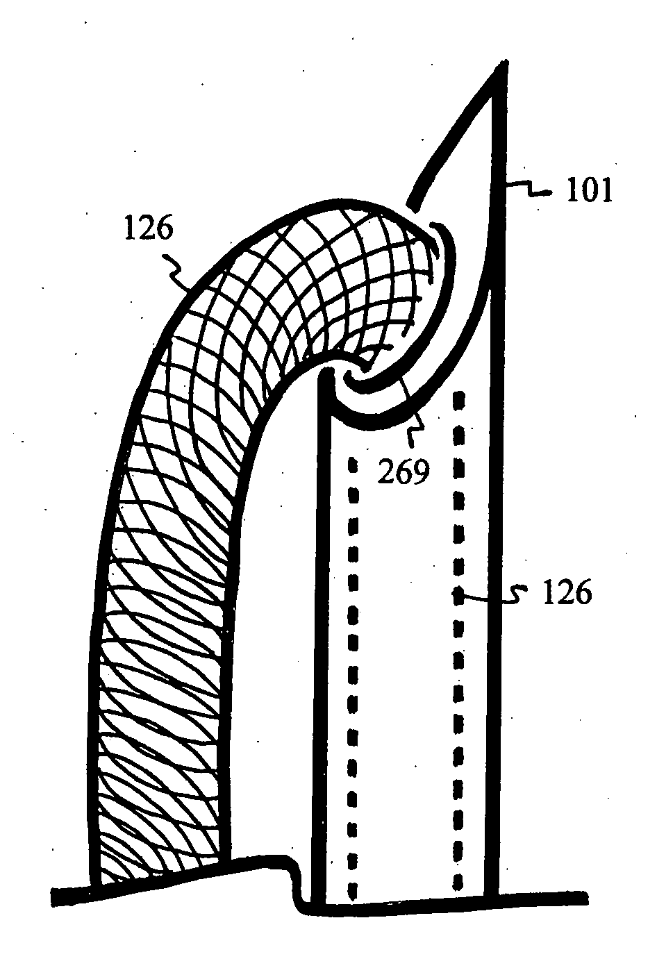 U-shaped disc shunt and delivery device