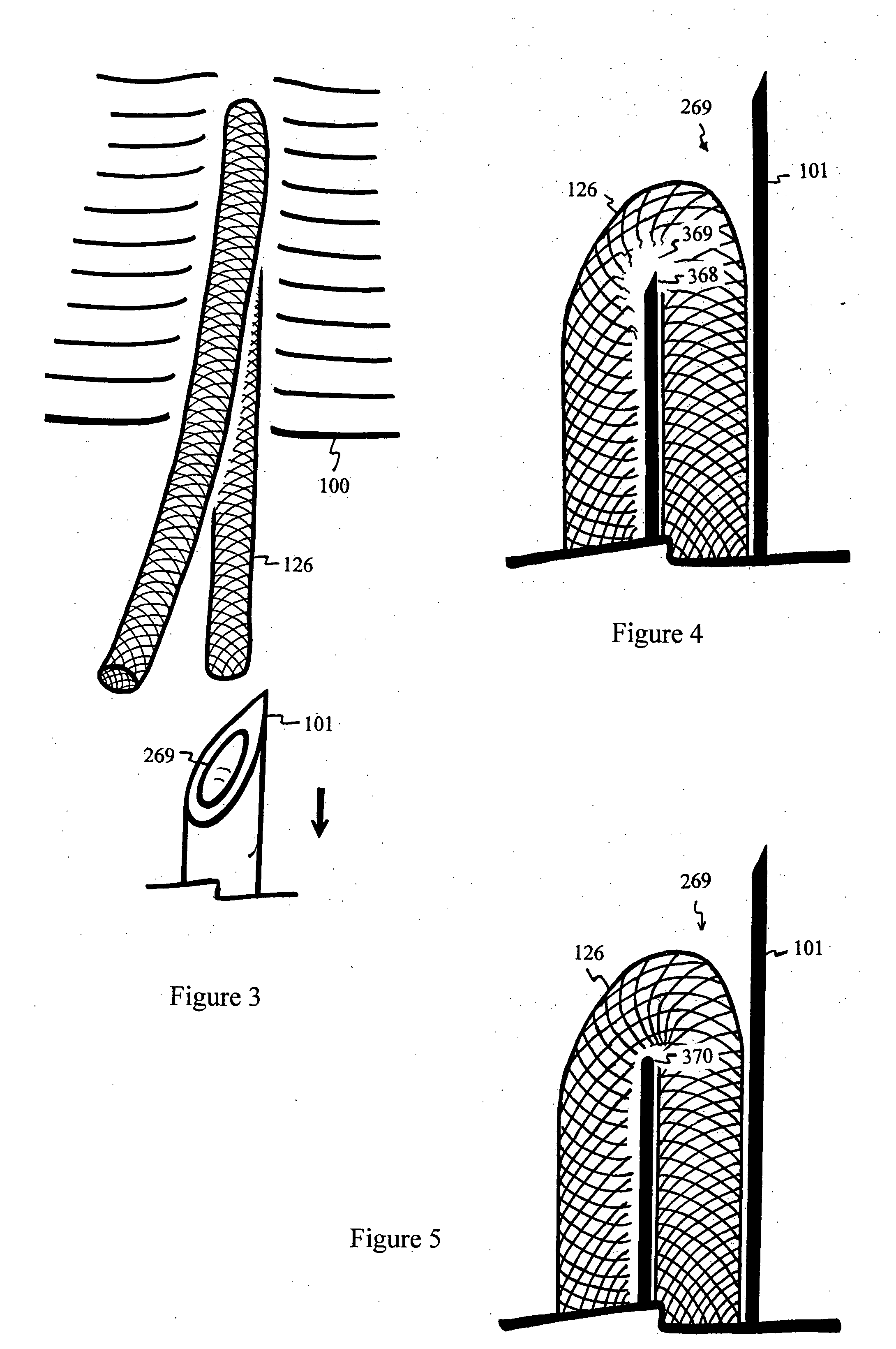 U-shaped disc shunt and delivery device