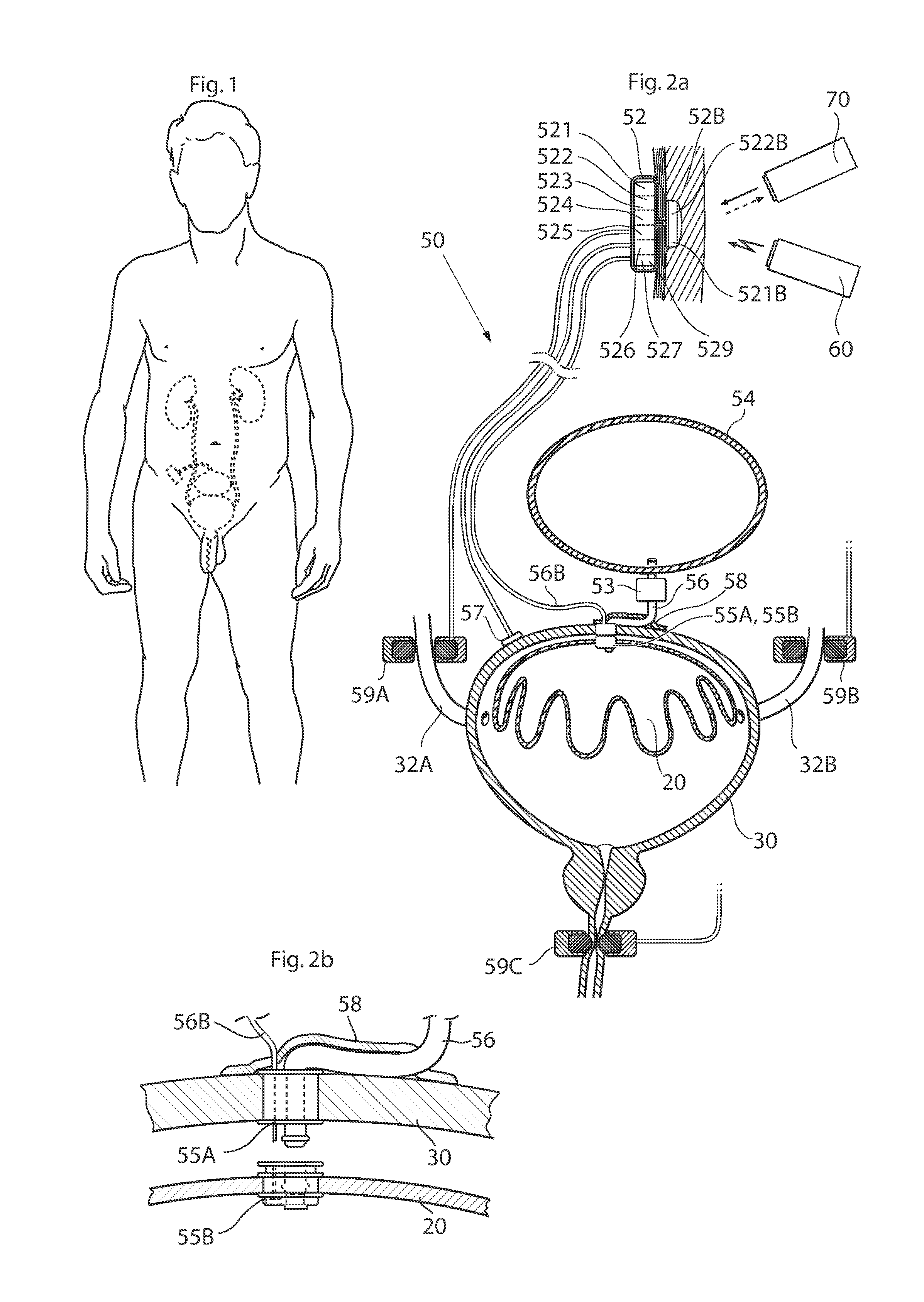 Implantable device for internal urinary control