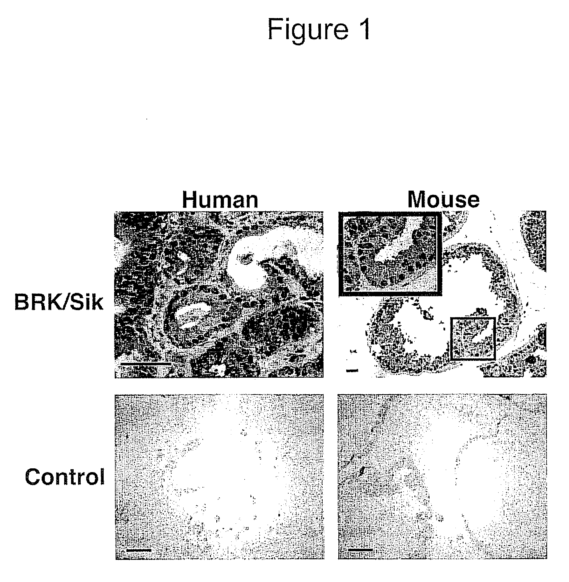 Altered Intracellular Localization of BRK/Sik Protein Tyrosine Kinase in Human Prostate Tumors