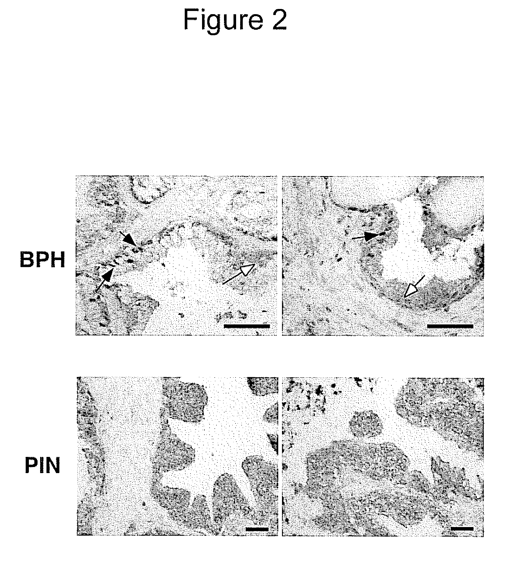 Altered Intracellular Localization of BRK/Sik Protein Tyrosine Kinase in Human Prostate Tumors