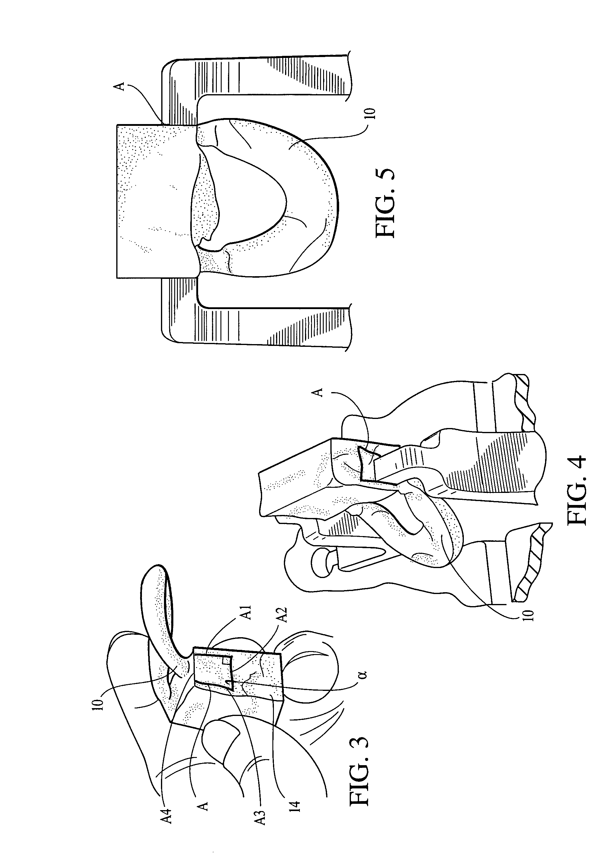 Dovetail meniscal allograft technique and system