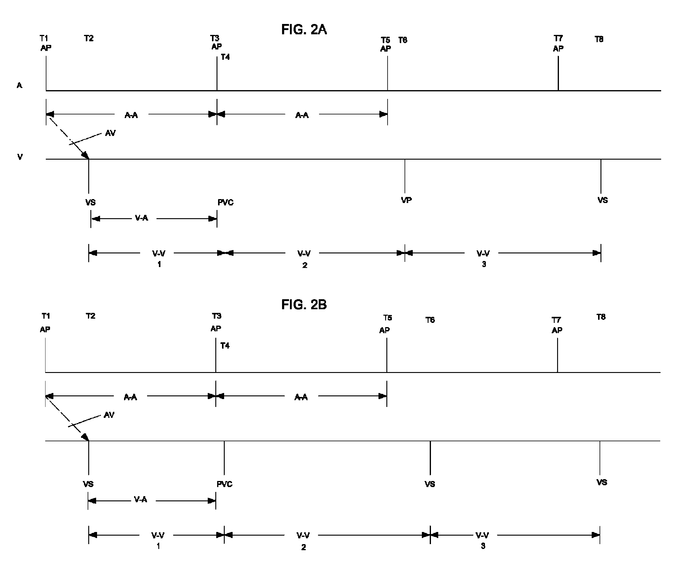 System and method for ventricular interval smoothing following a premature ventricular contraction