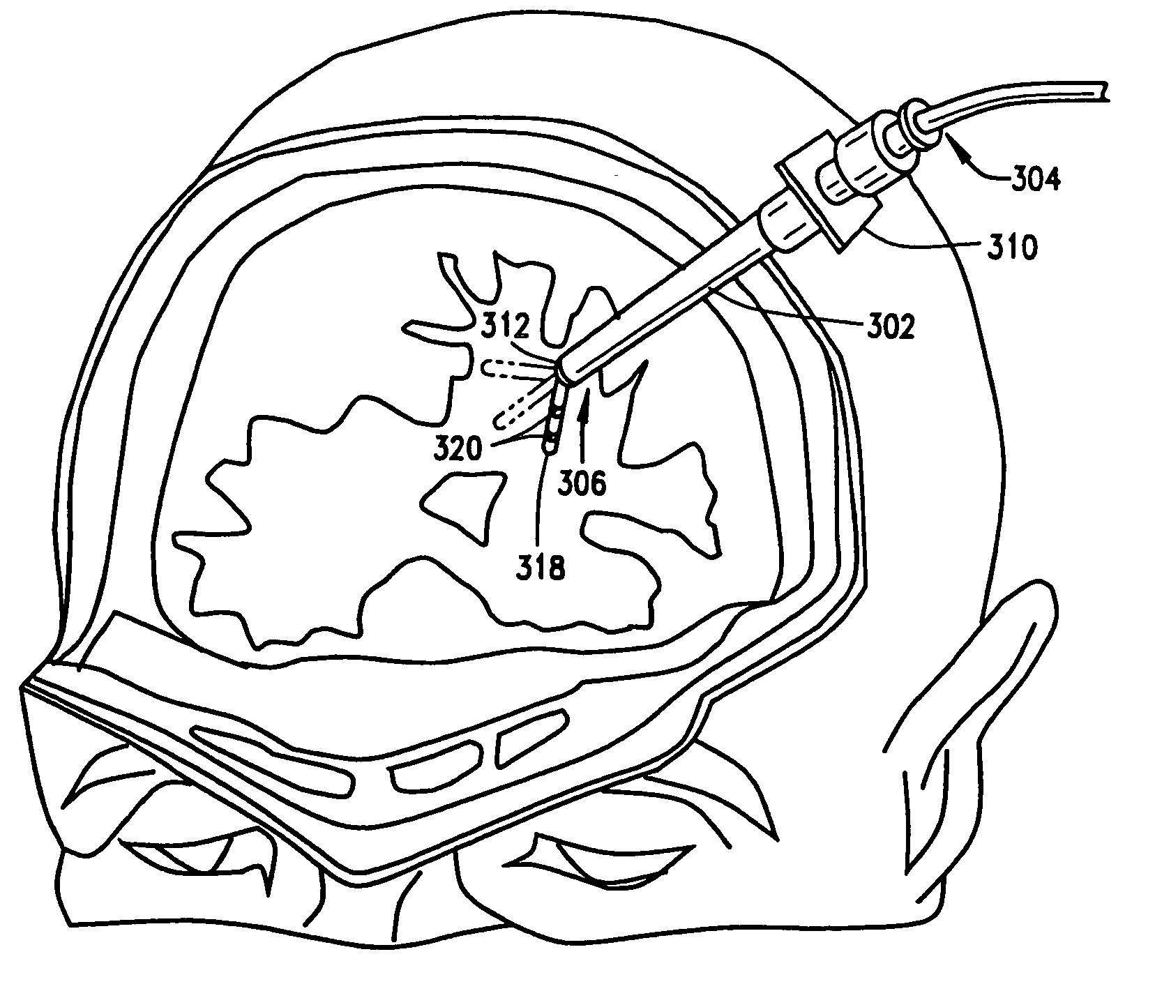 Guide for medical devices