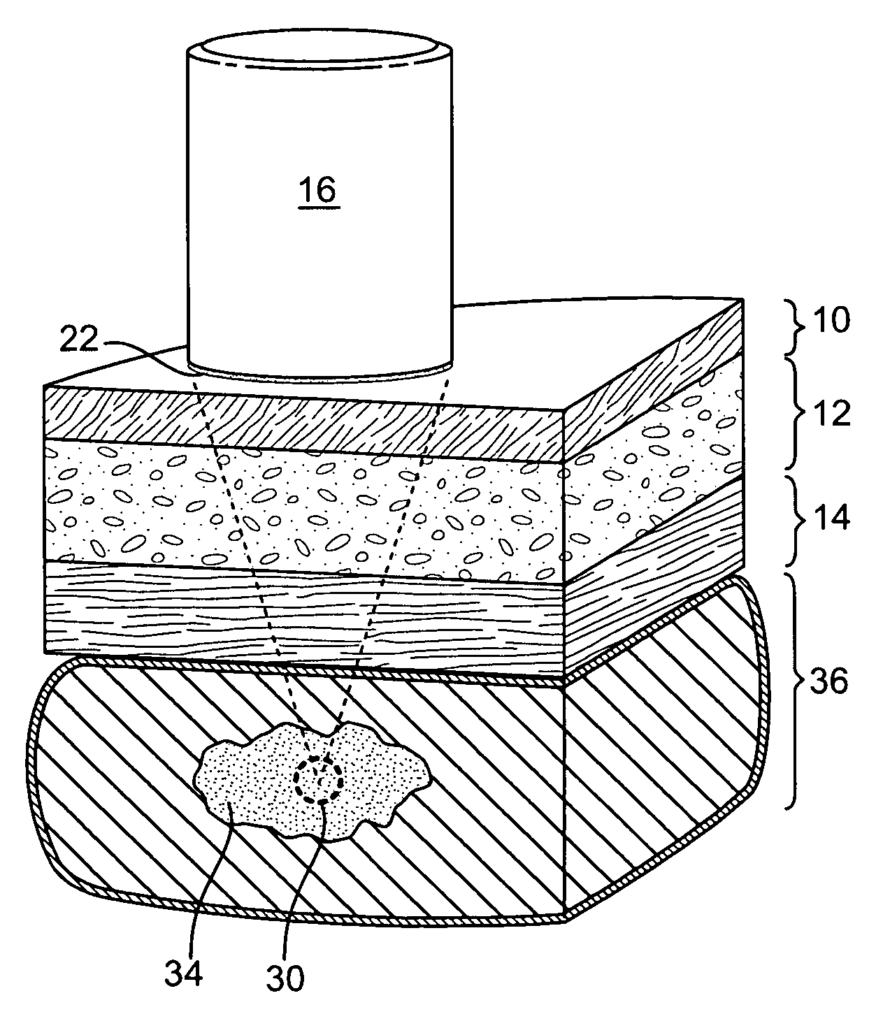 Methods and apparatus for coupling a HIFU transducer to a skin surface