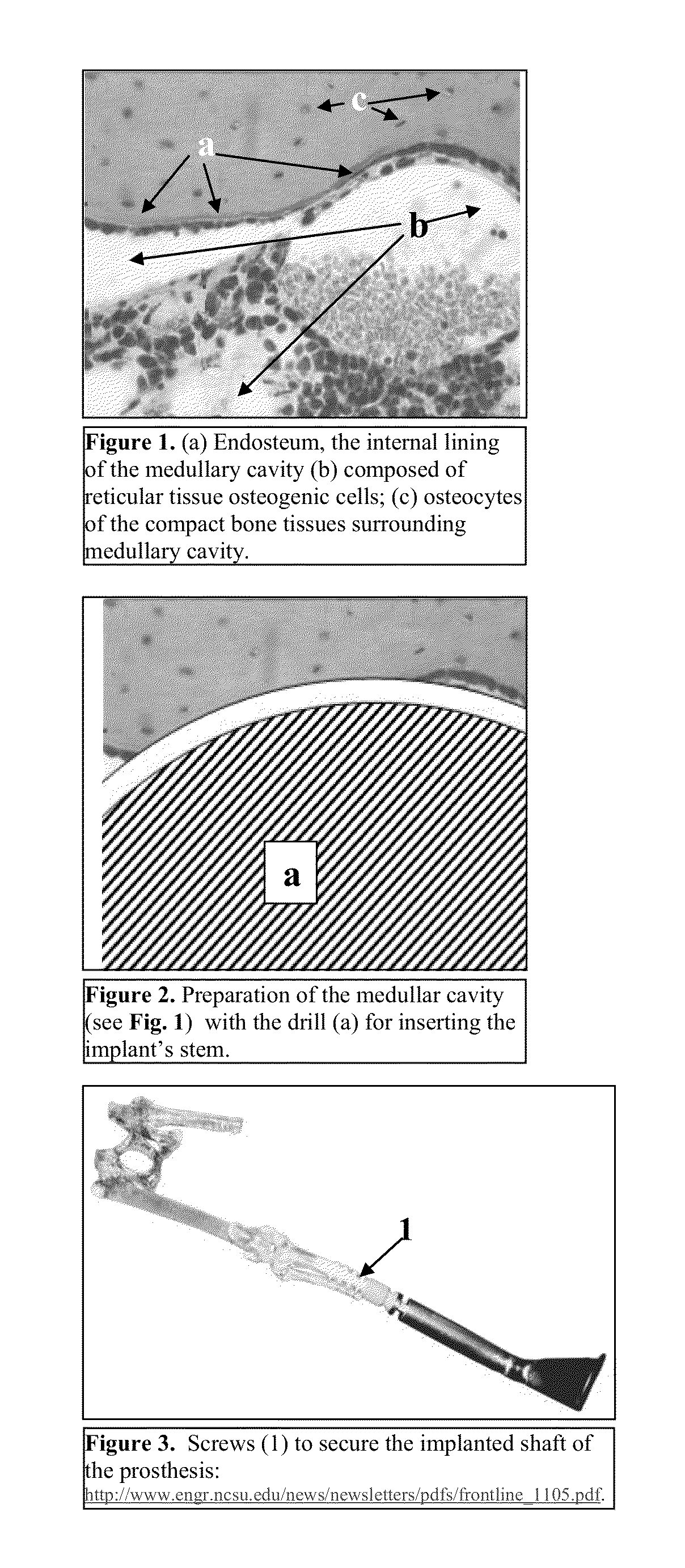 In-bone implantable shaft for prosthetic joints or for direct skeletal attachment of external limb prostheses and method of its installation