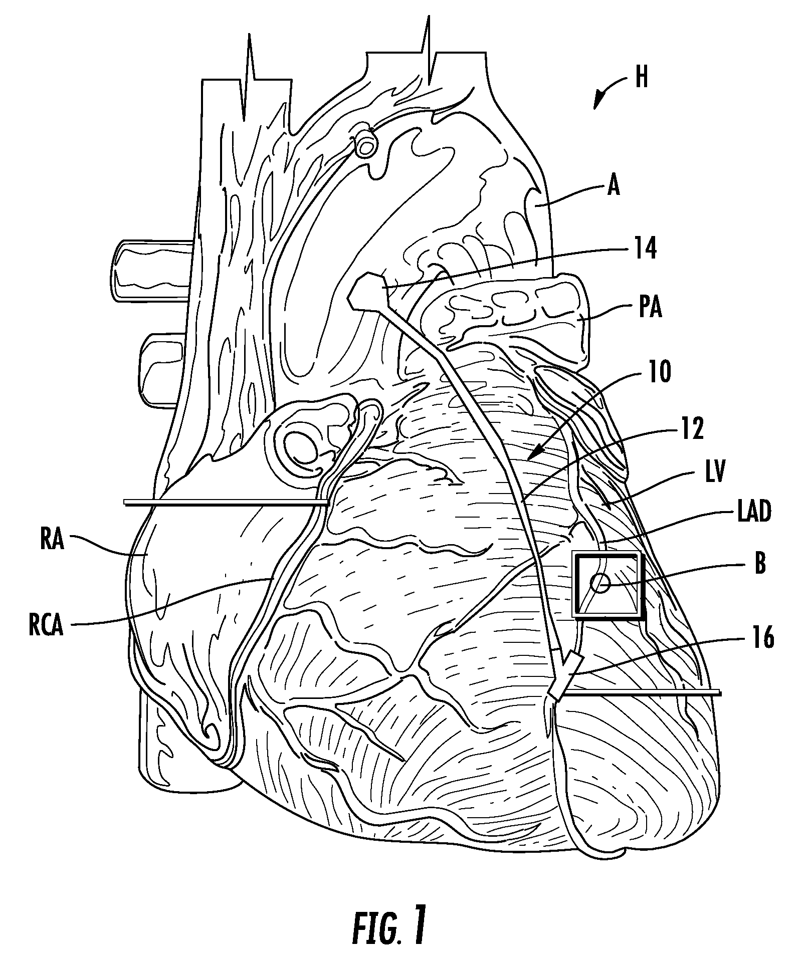 Method and apparatus for bypass graft