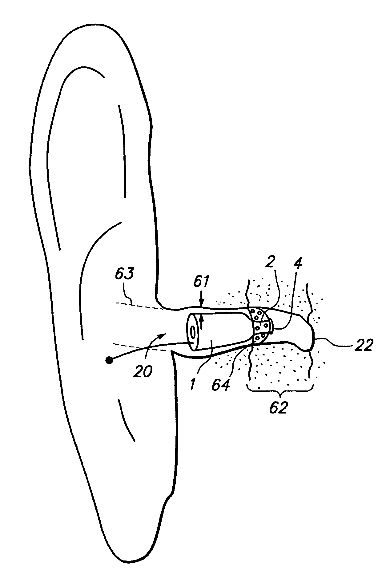 Open fit canal hearing device