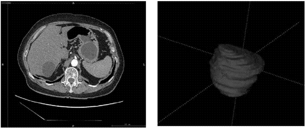 Construction method of gastrointestinal stromal tumor malignant potential classification model based on support vector machine