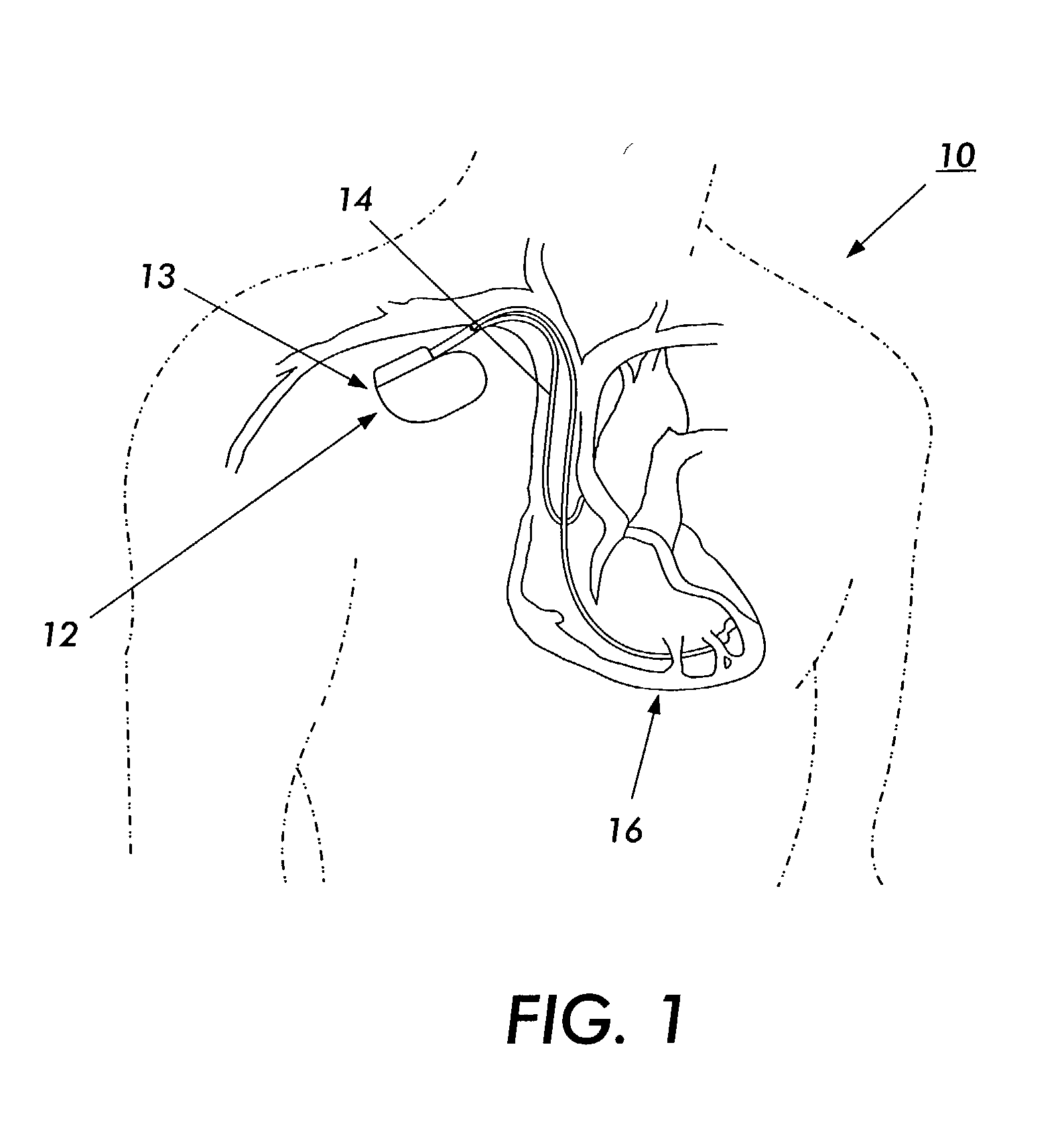 Electromagnetic interference immune tissue invasive system