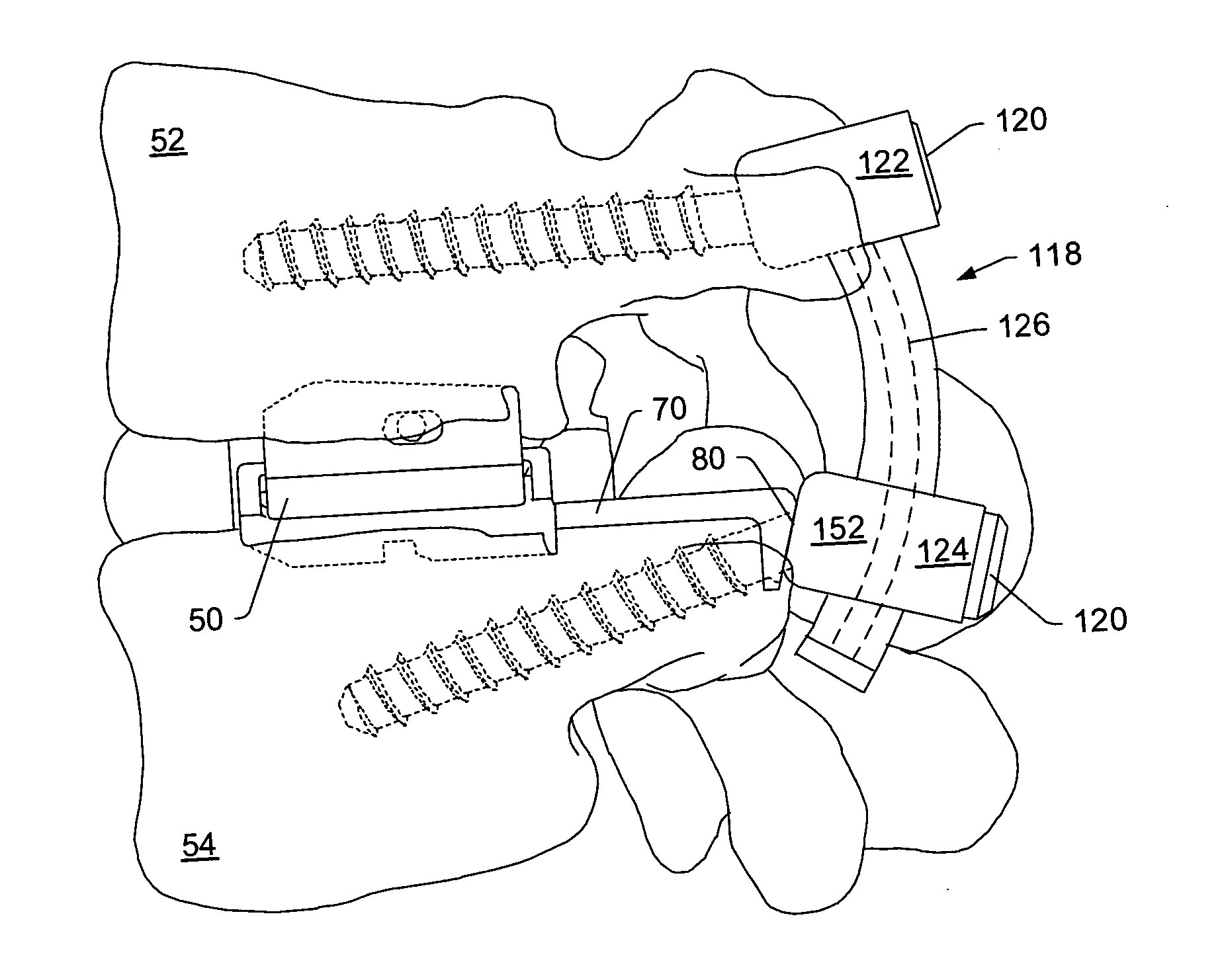 Artificial functional spinal unit system and method for use