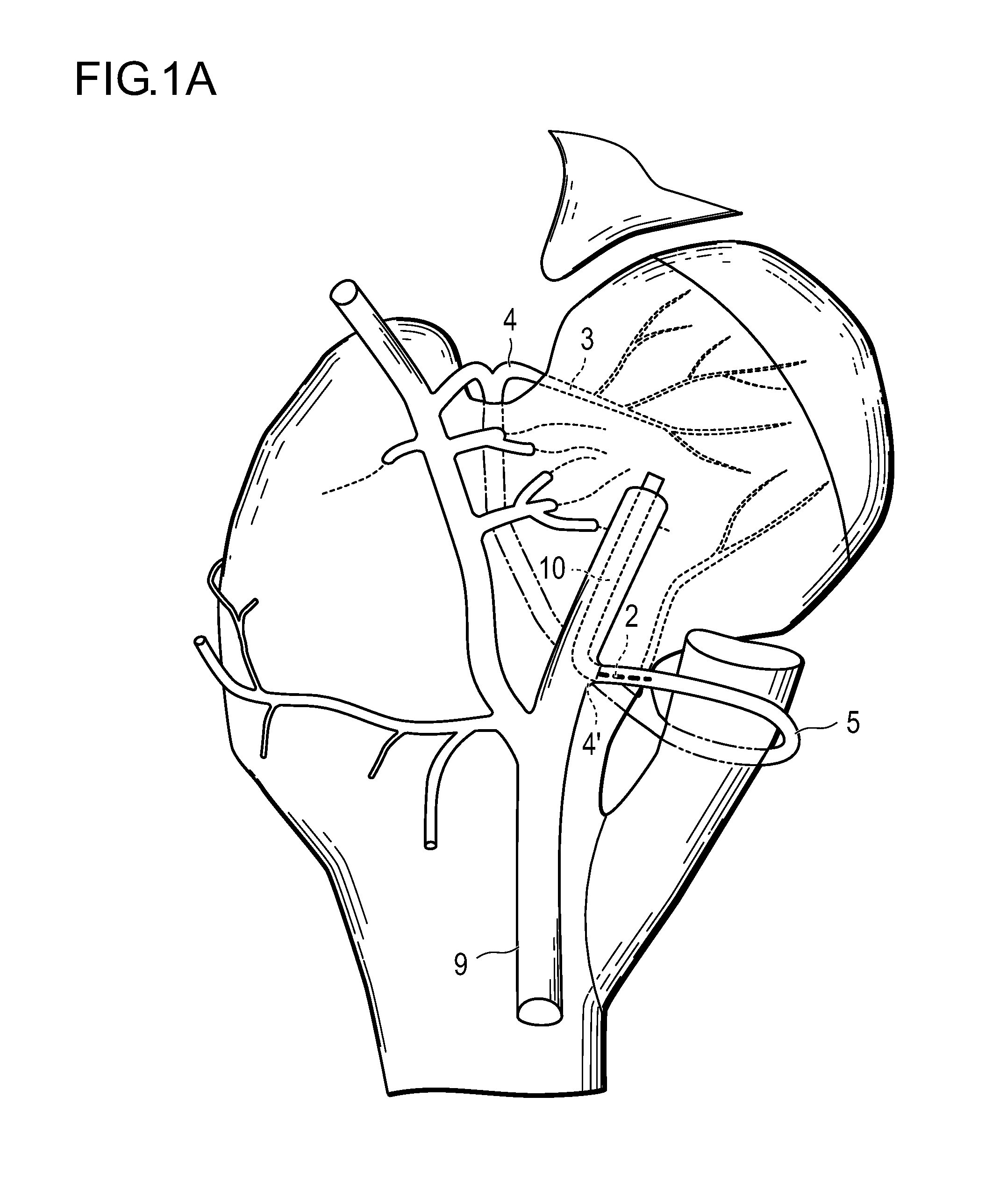 Method for improving blood flow in bone head