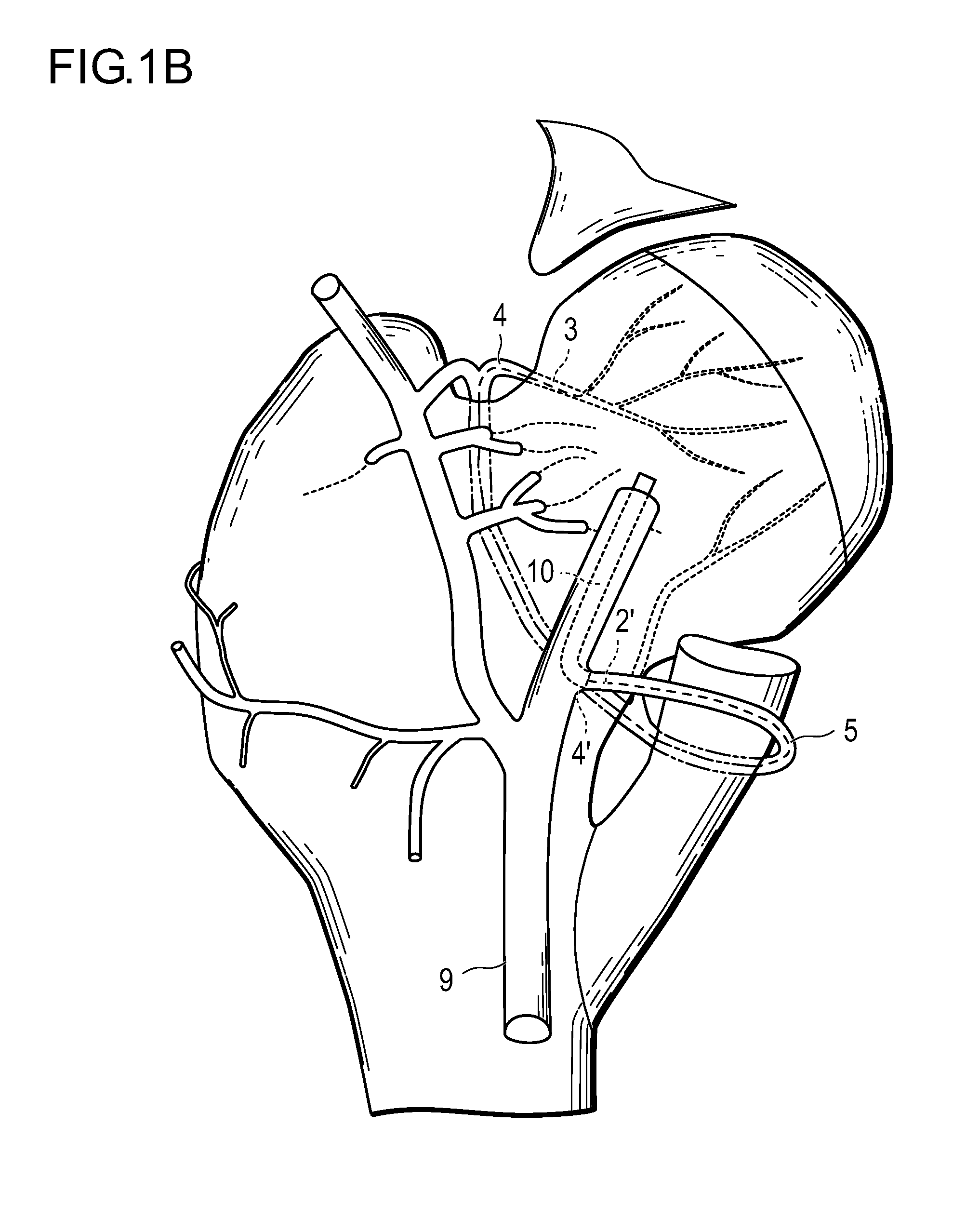 Method for improving blood flow in bone head