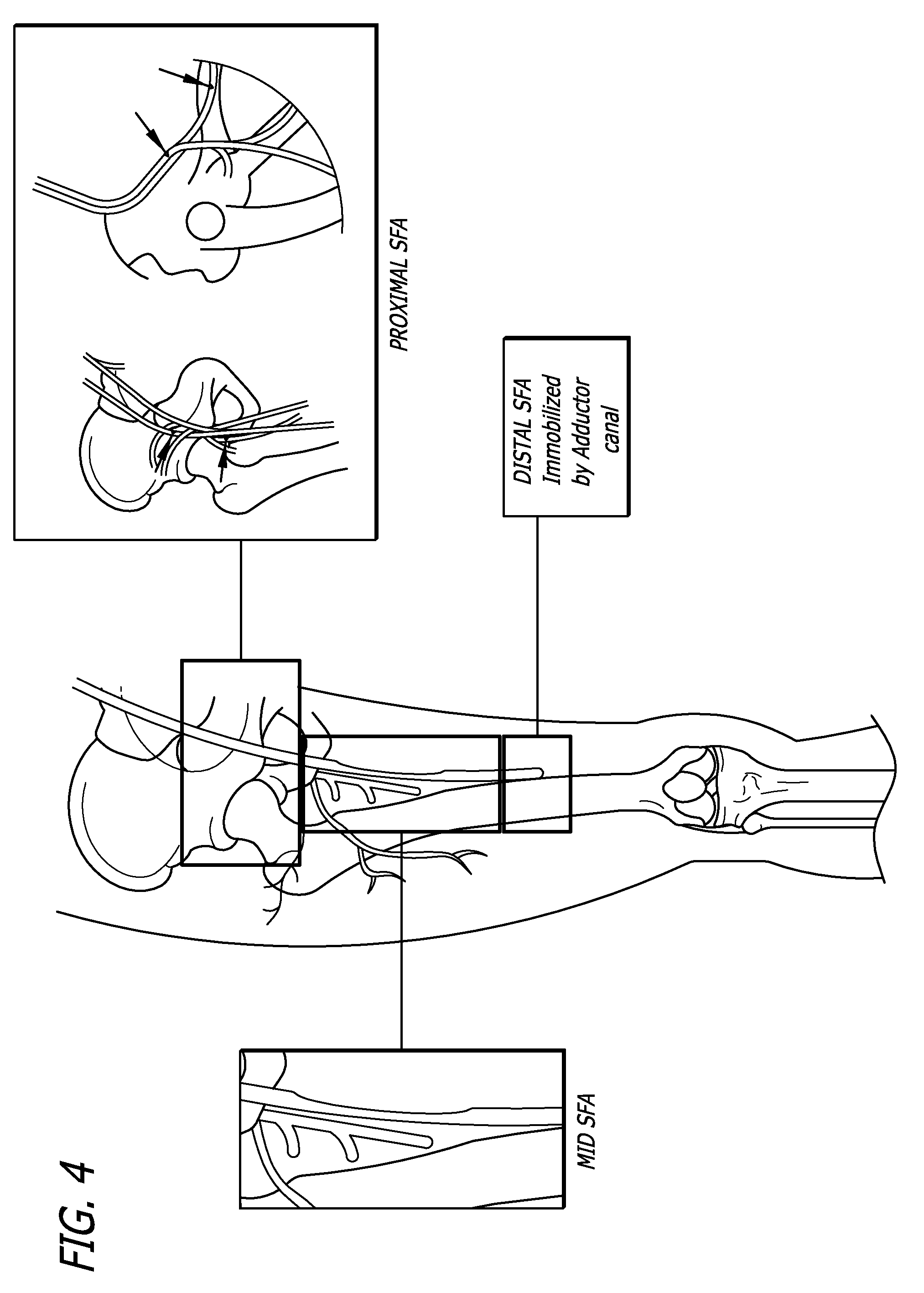 Endoprostheses for peripheral arteries and other body vessels