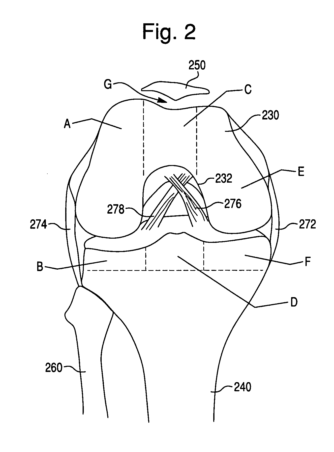 Multi-compartmental prosthetic device with patellar component transition