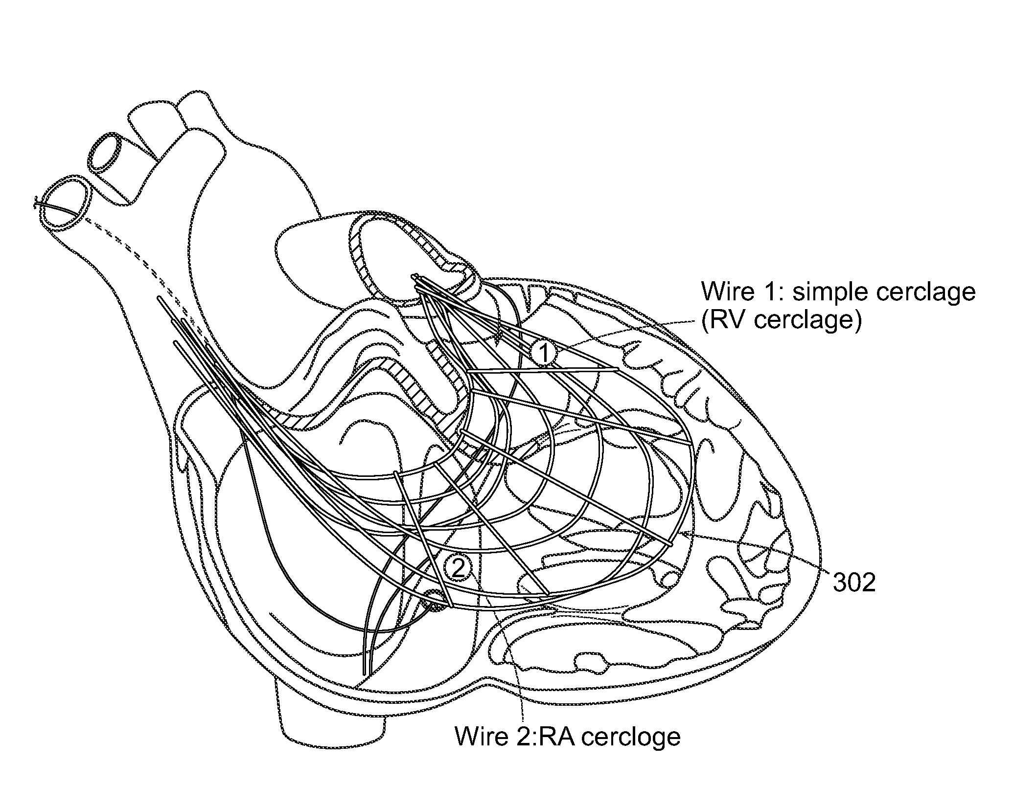 Methods and devices for transcatheter cerclage annuloplasty