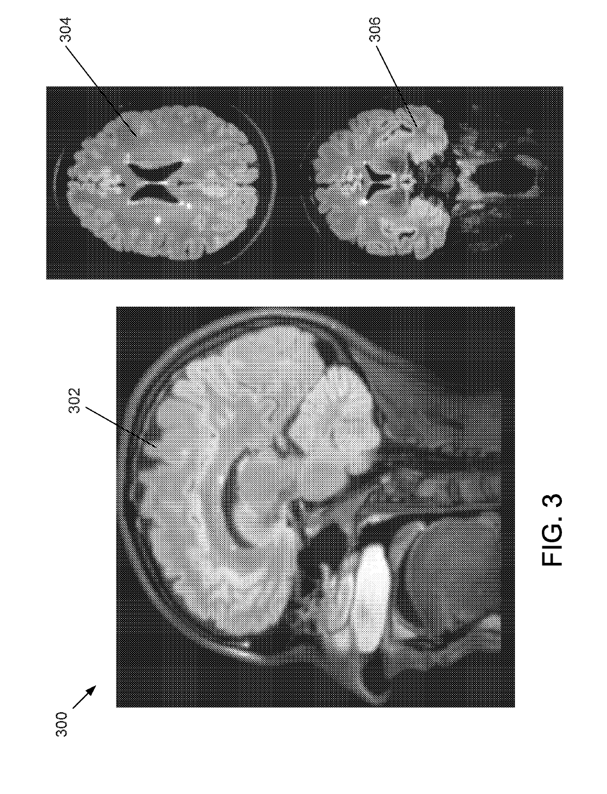 Methods, apparatuses, and systems for creating 3-dimensional representations exhibiting geometric and surface characteristics of brain lesions