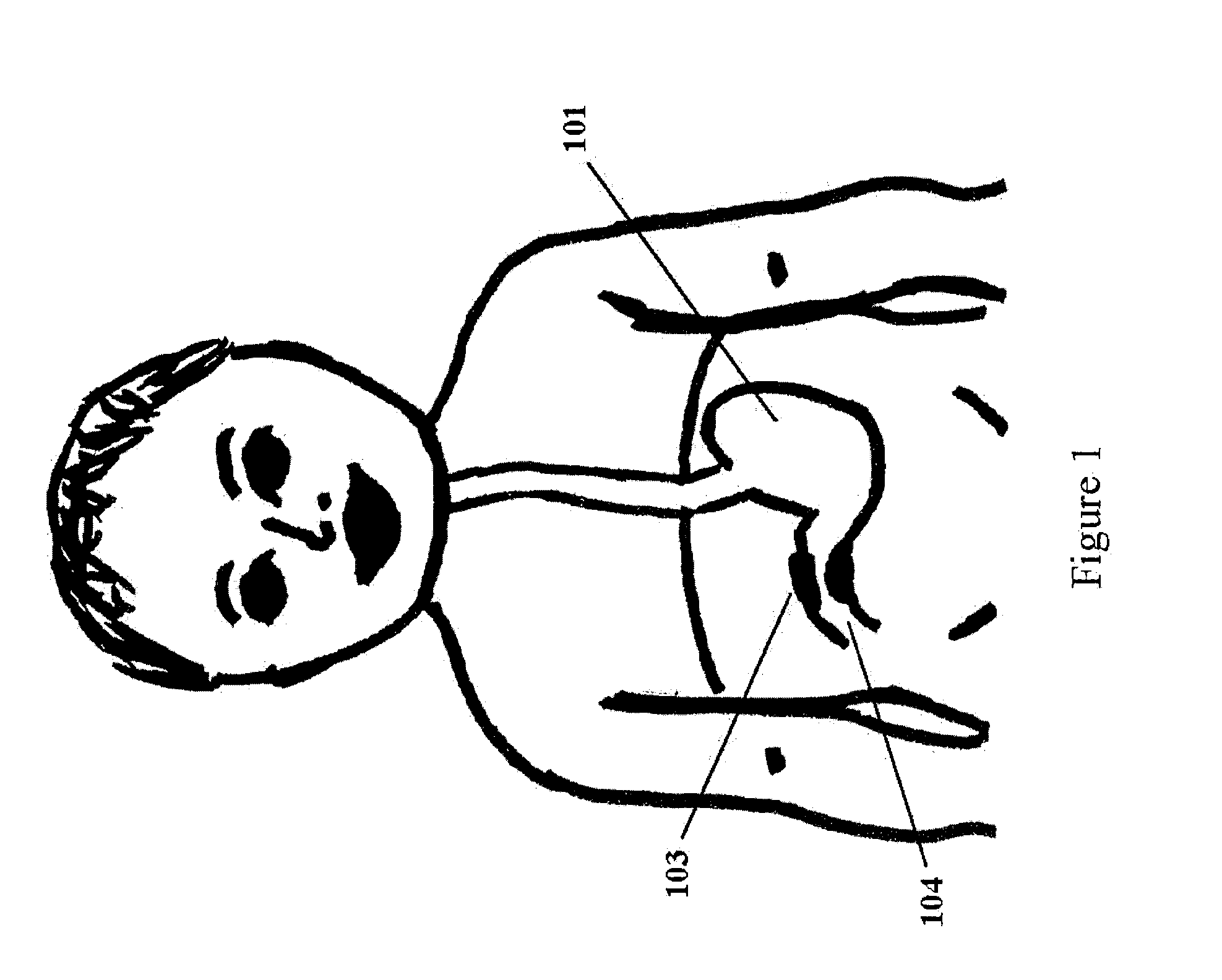 Endopyloric tool and method to treat hypertropic pyloric stenosis