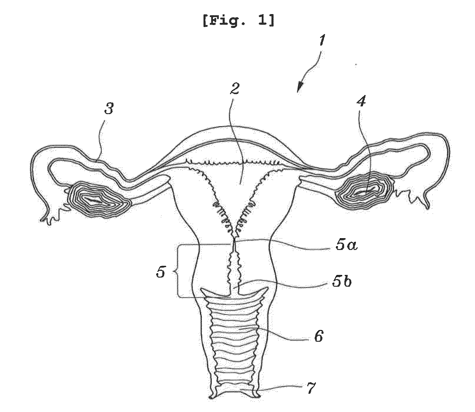 Amniotic fluid collector