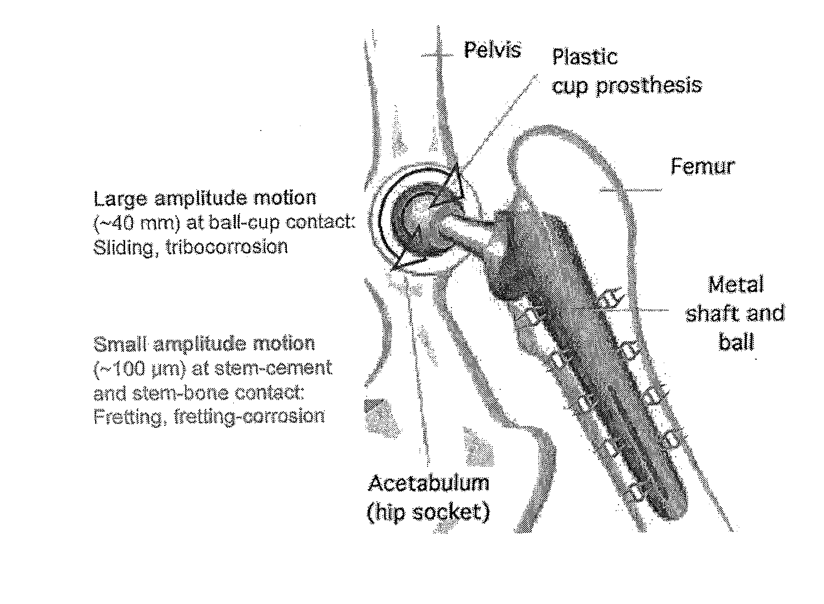 In-vivo condition monitoring of metallic implants by electrochemical techniques