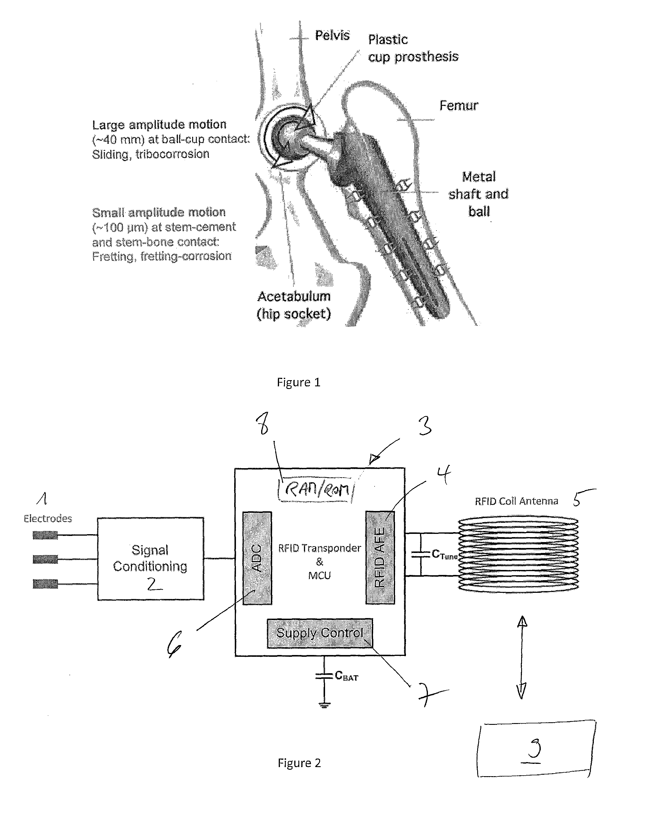 In-vivo condition monitoring of metallic implants by electrochemical techniques