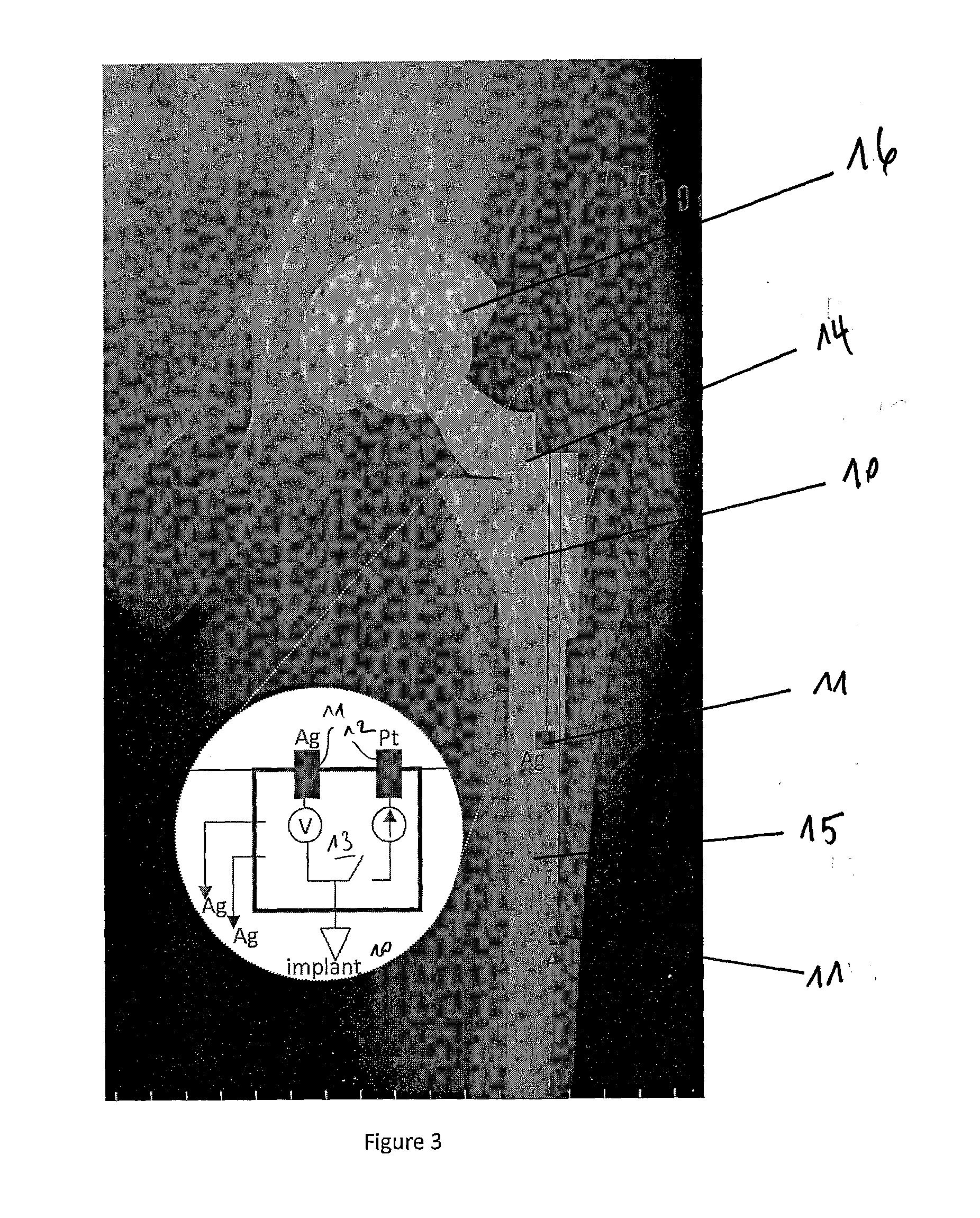 In-vivo condition monitoring of metallic implants by electrochemical techniques