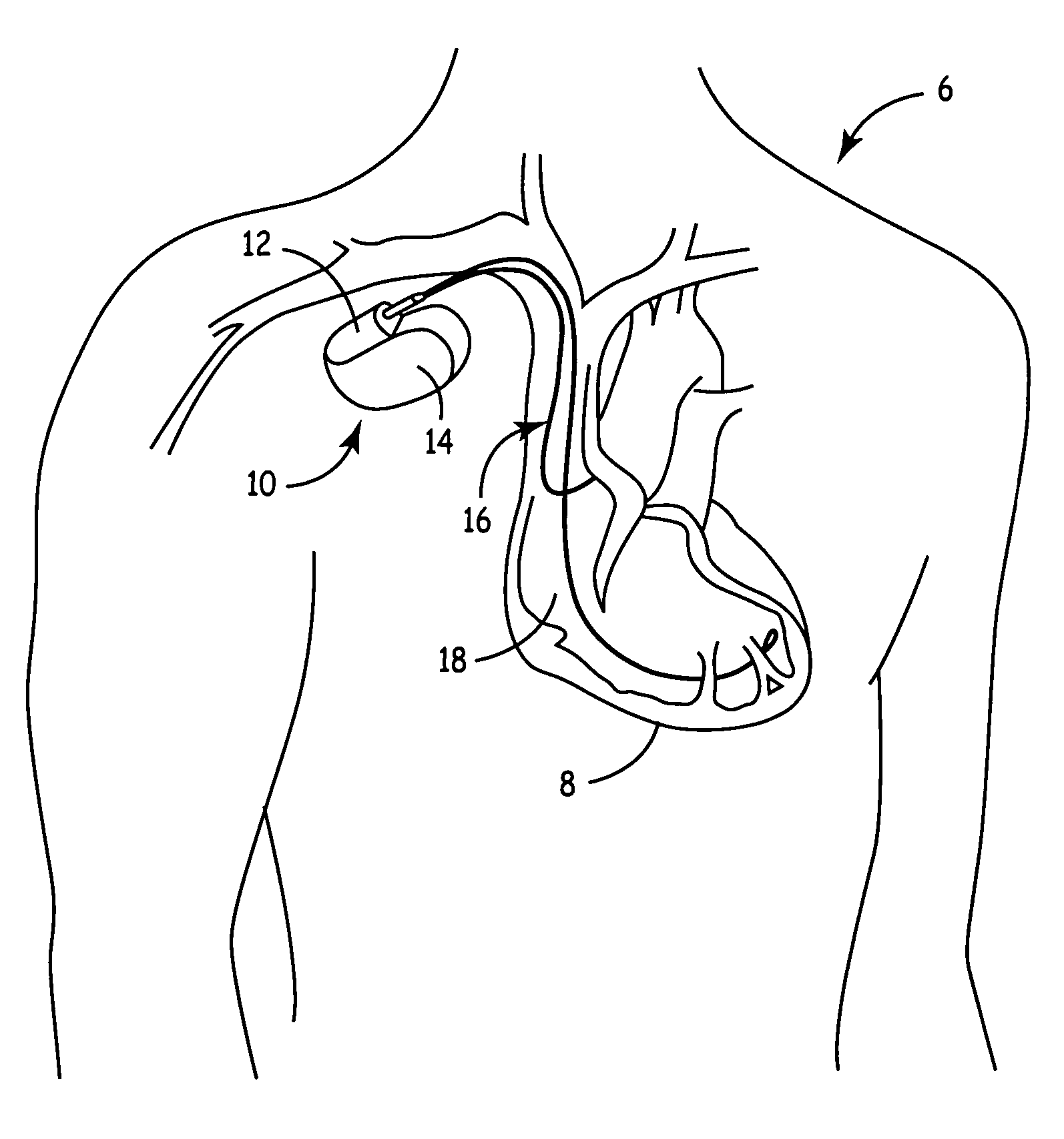 Implantable medical device with ventricular pacing protocol