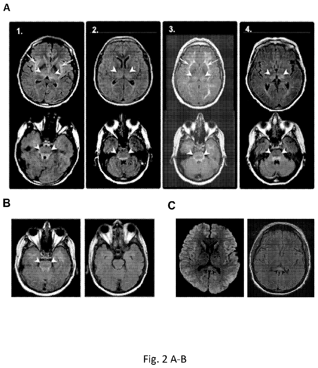 Diagnosis and treatment of immunotherapy-induced neurotoxicity