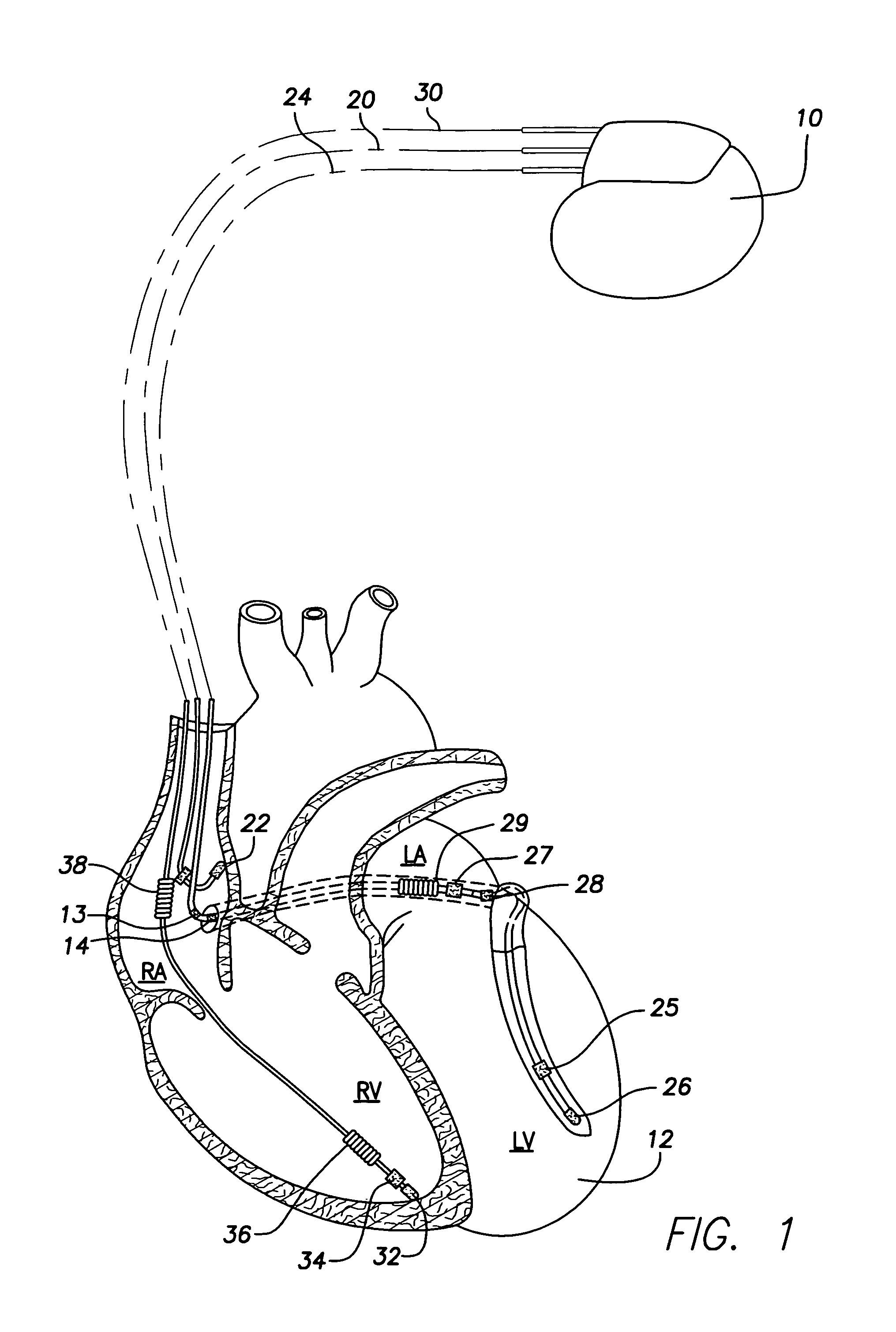 Anti-tachycardia pacing method and apparatus for multi-chamber pacing