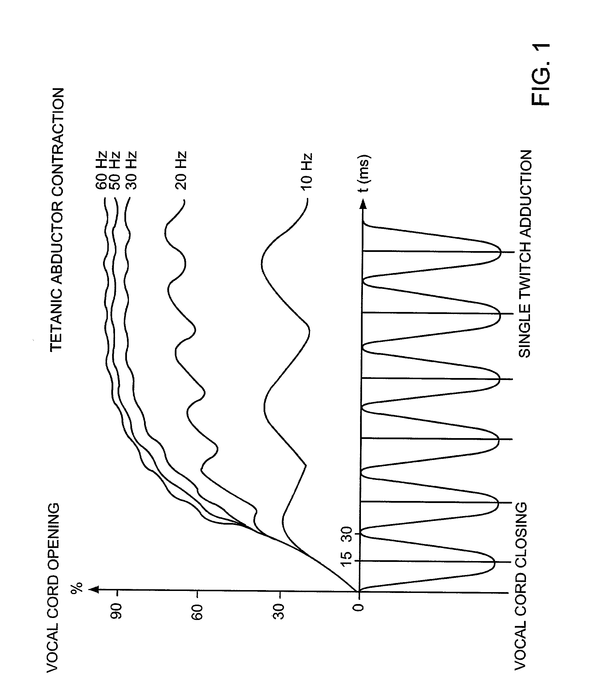 Pacemaker for bilateral vocal cord autoparalysis