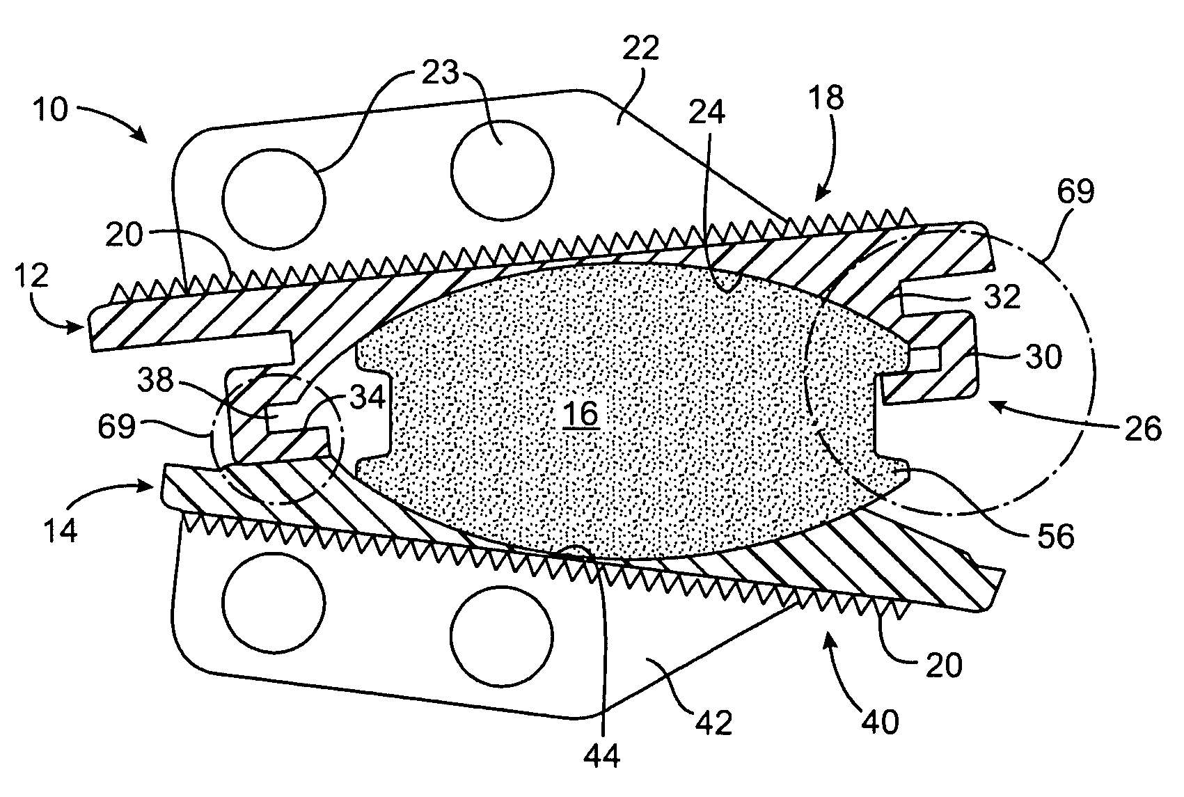 Intervertebral prosthetic disc with metallic core