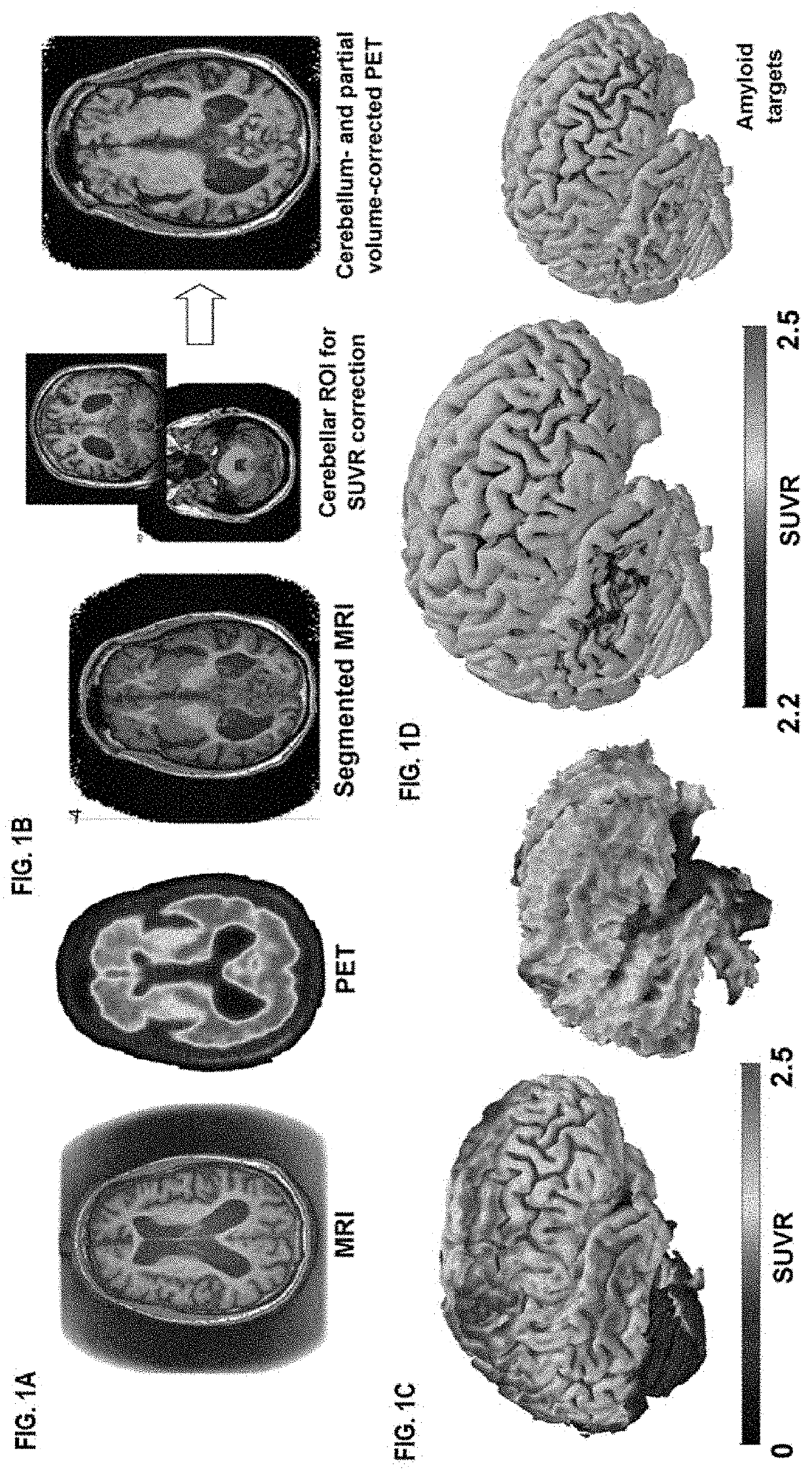 Systems and methods for treating brain disease using targeted neurostimulation