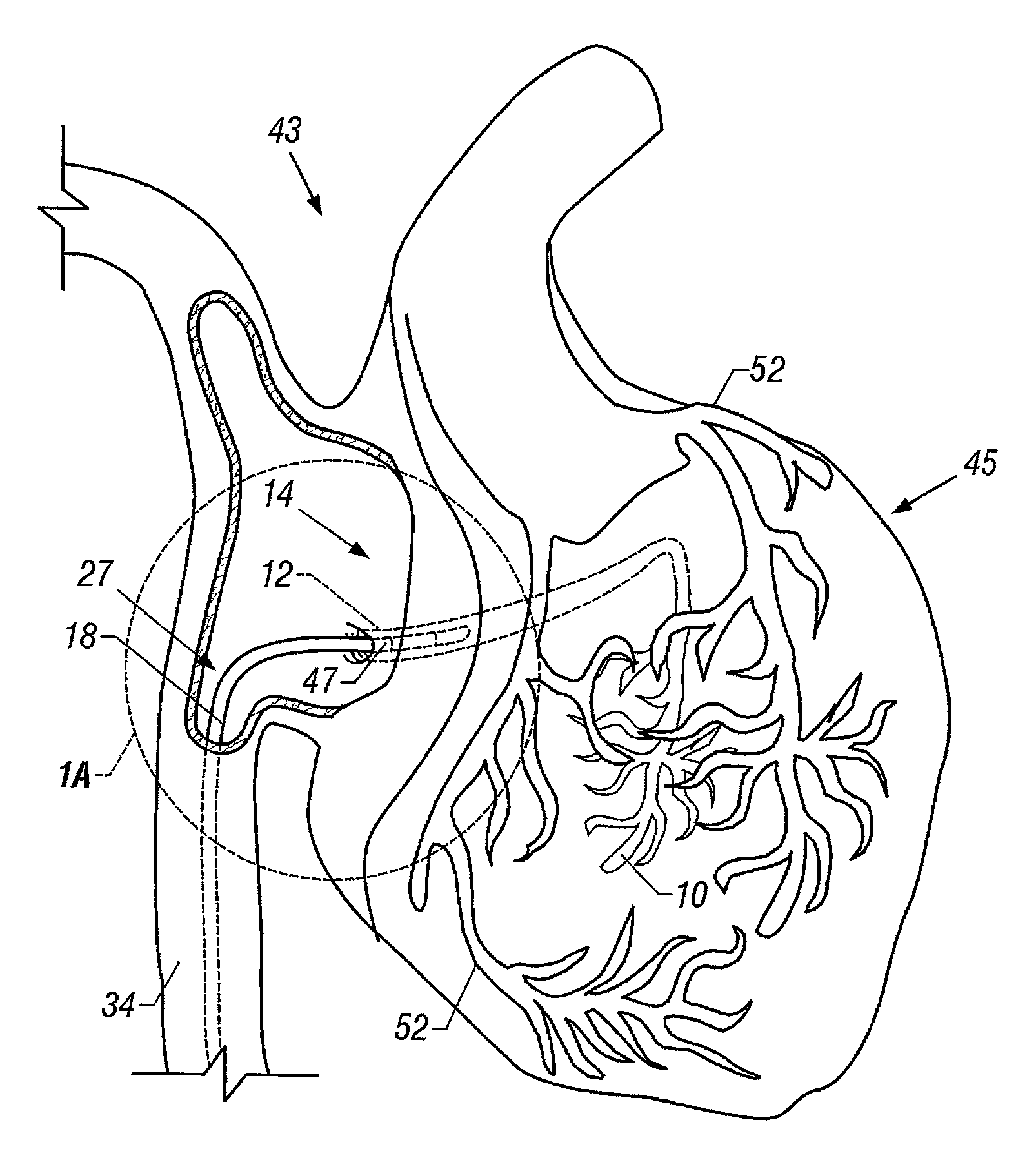 Method and apparatus to remove substances from vessels of the heart and other parts of the body to minimize or avoid renal or other harm or dysfunction