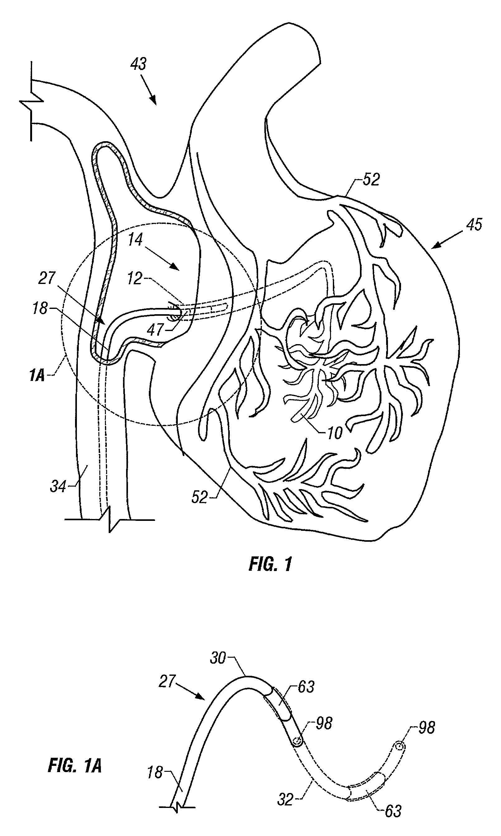 Method and apparatus to remove substances from vessels of the heart and other parts of the body to minimize or avoid renal or other harm or dysfunction