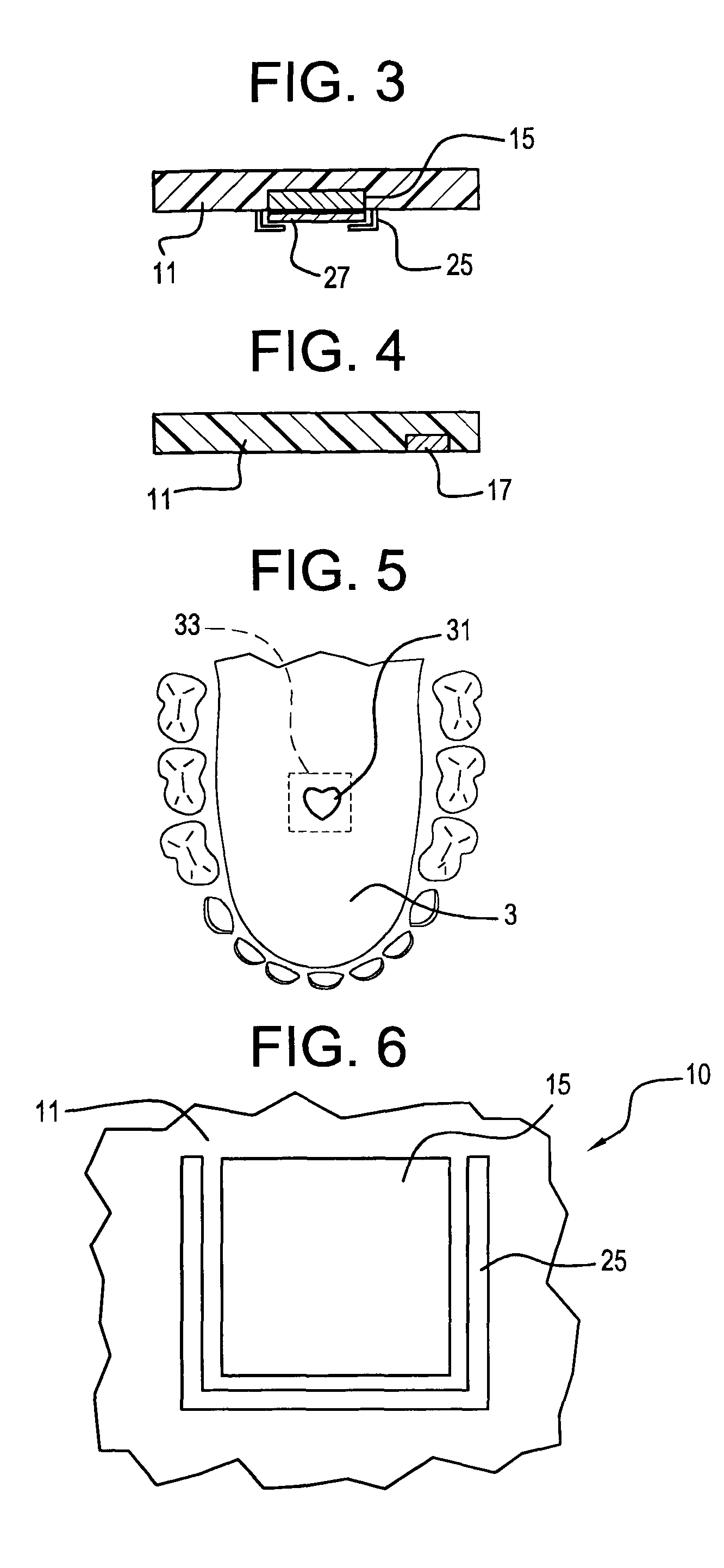 Illuminated orthodontic retainer