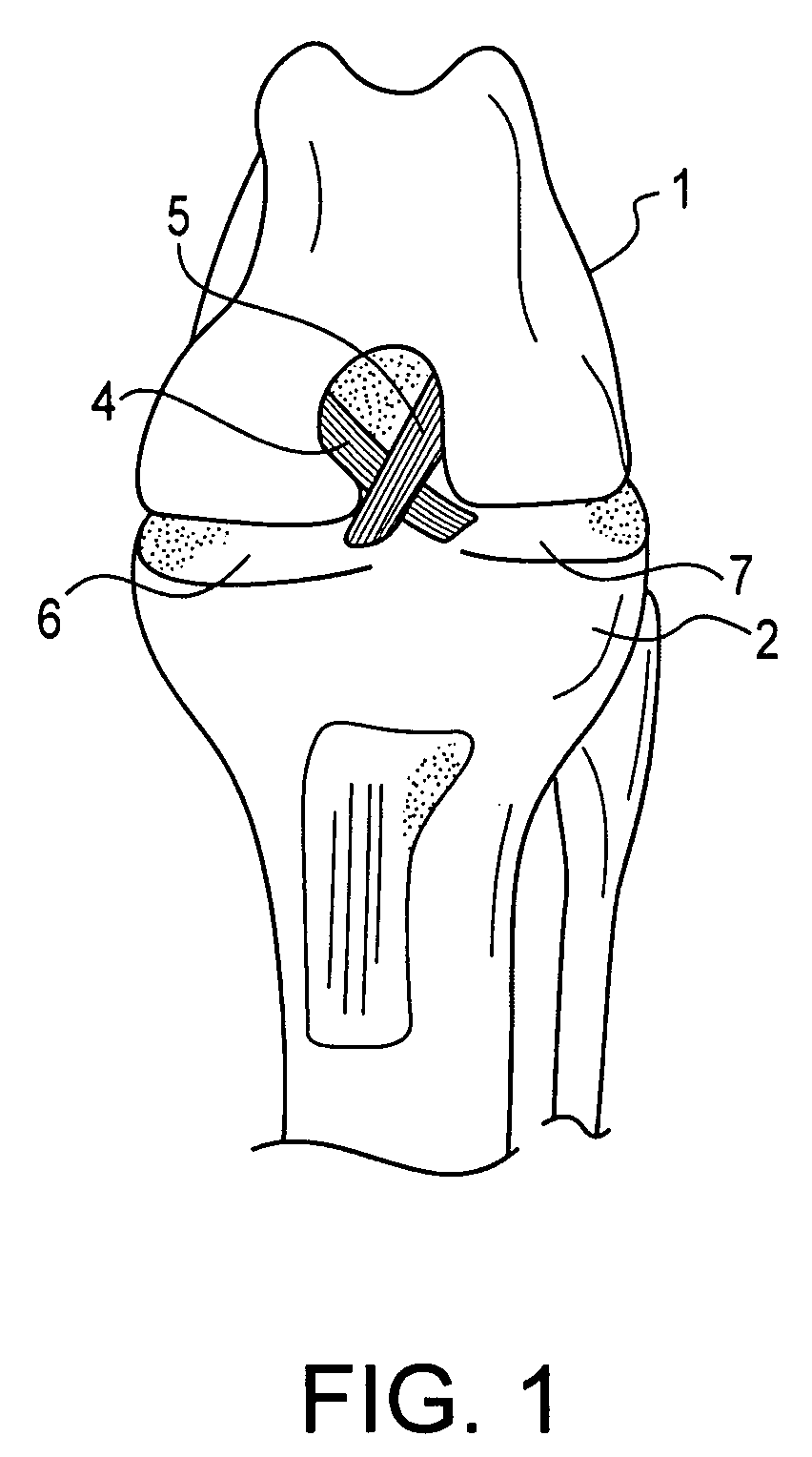 Method and suture-button construct for stabilization of cranial cruciate ligament deficient stifle