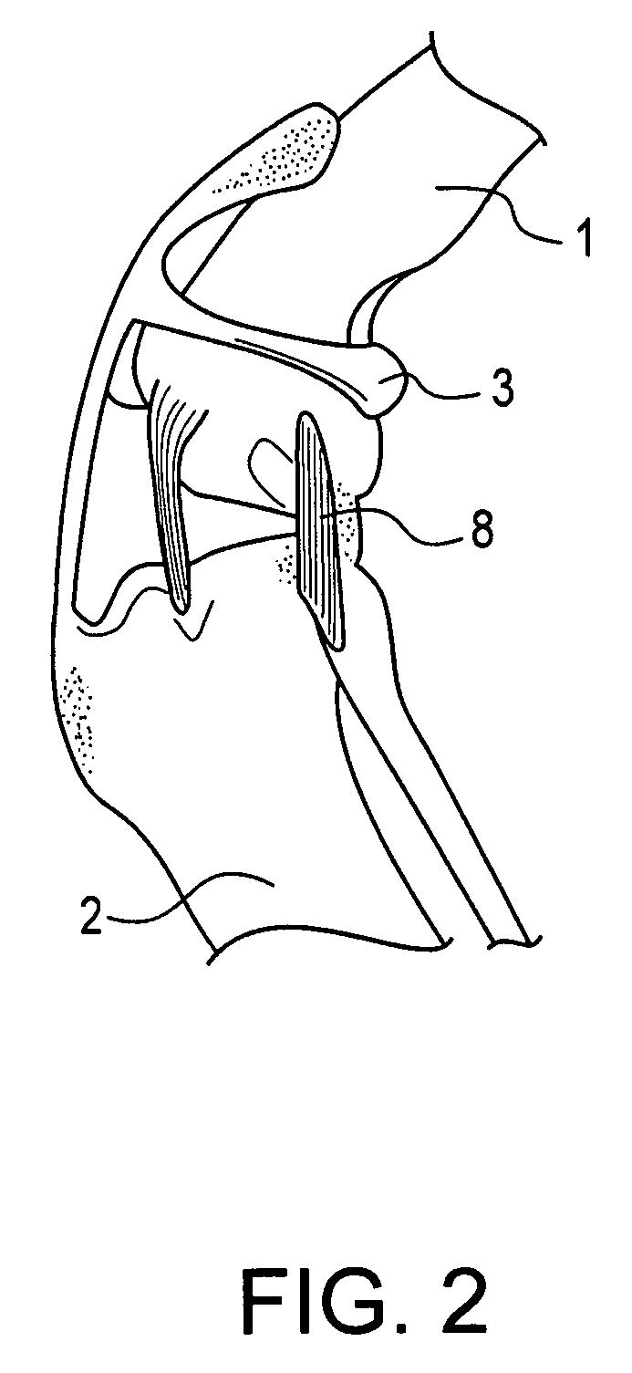 Method and suture-button construct for stabilization of cranial cruciate ligament deficient stifle