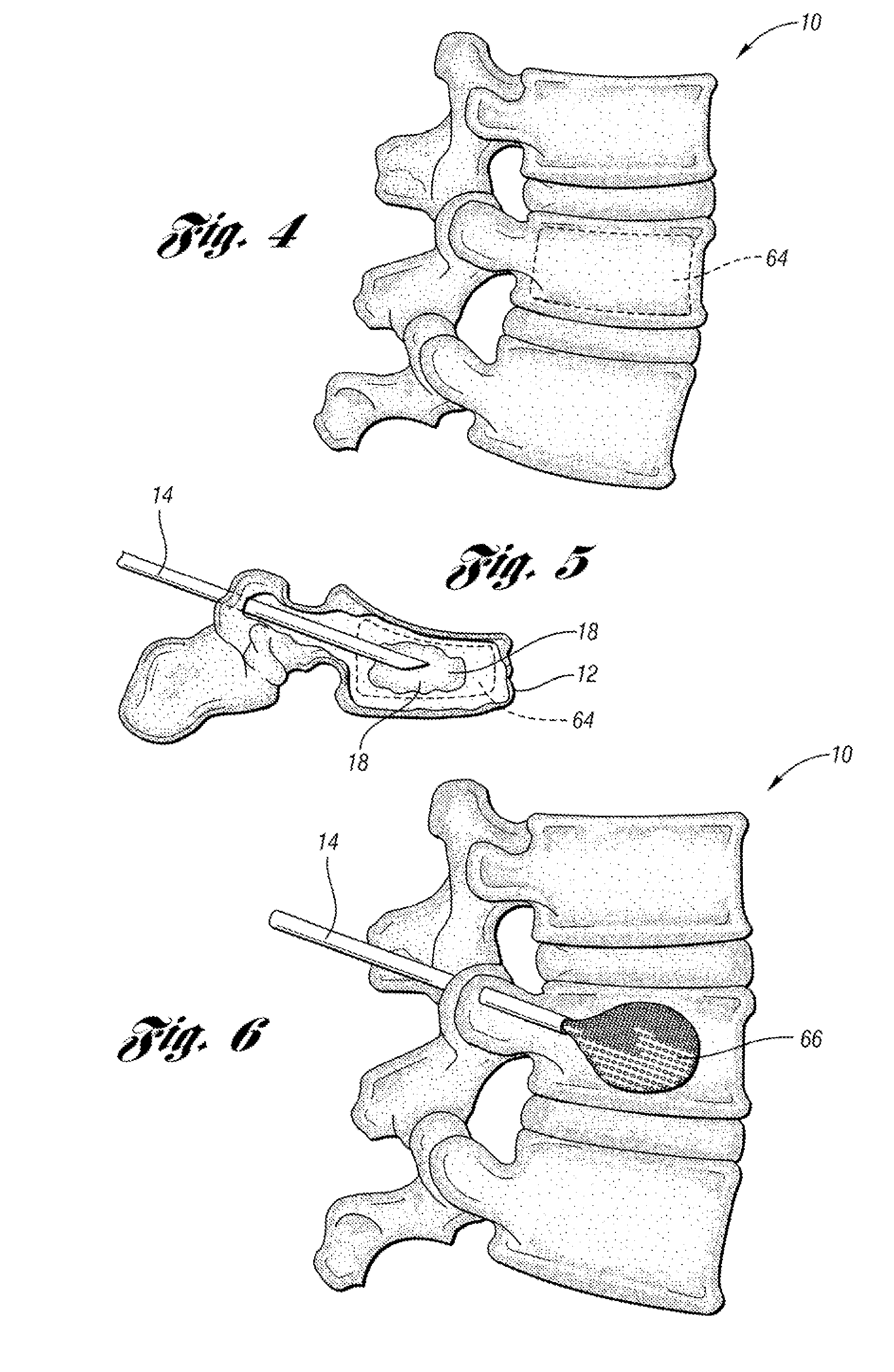 Bone cement mixing and delivery device and method of use