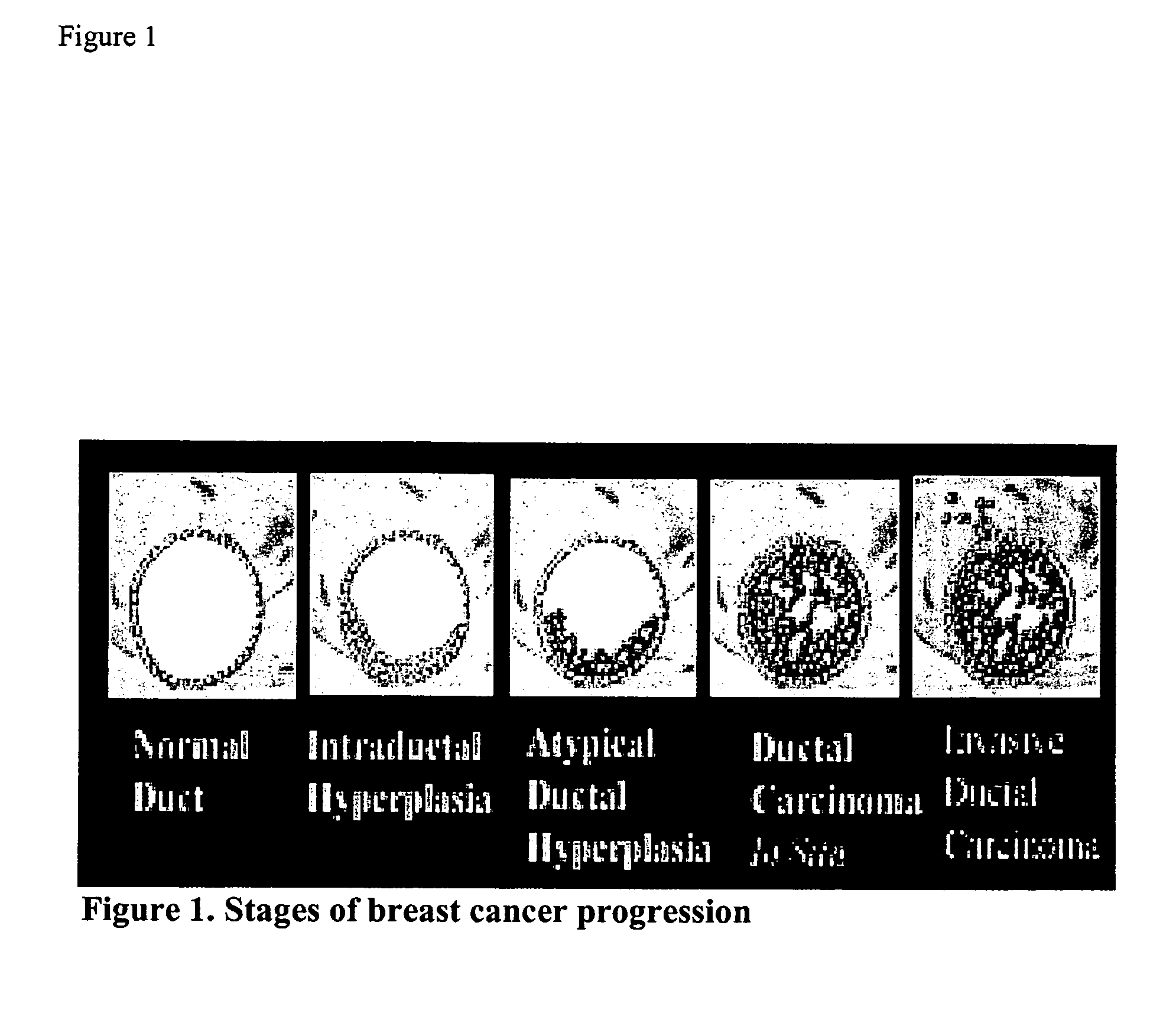 Molecular Markers that predict breast cancer development