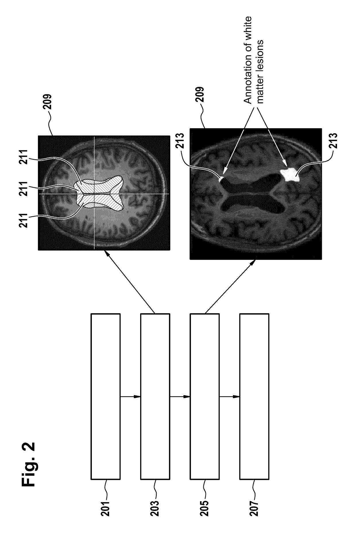 Medical instrument for analysis of white matter brain lesions