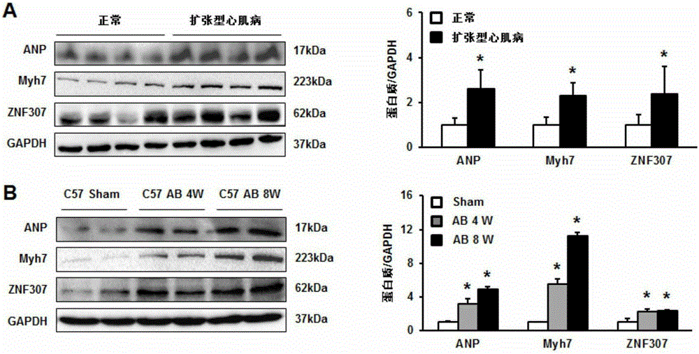 Application of zinc finger protein 307 (ZNF307) in treating myocardial hypertrophy