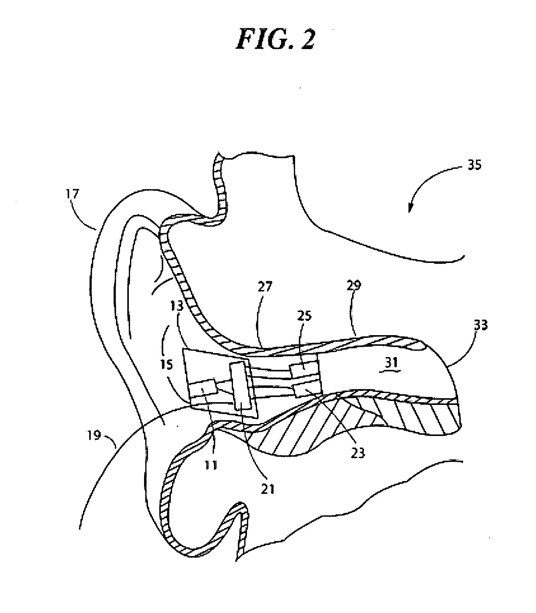 Ear input sound pressure level monitoring system