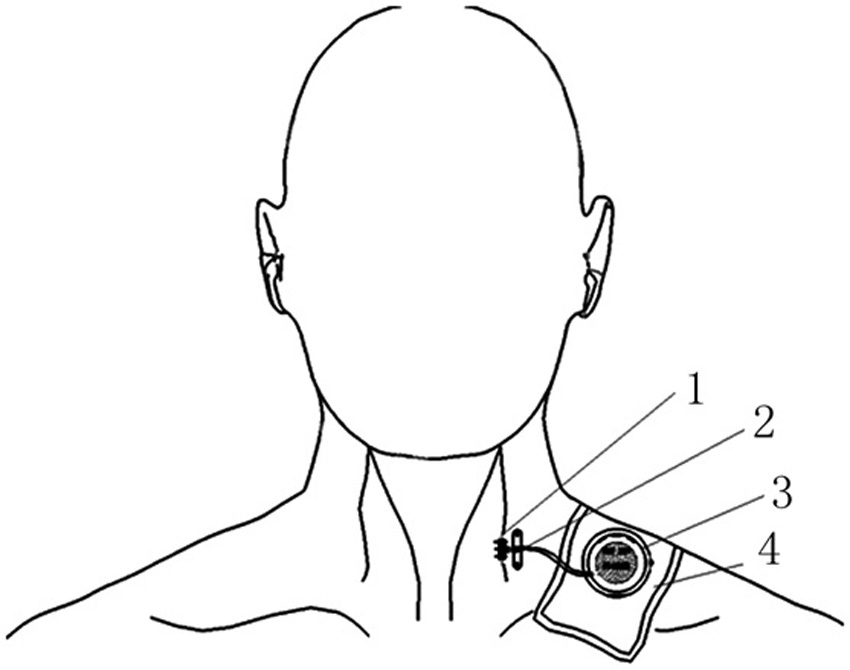 Minimally invasive electrical stimulation system