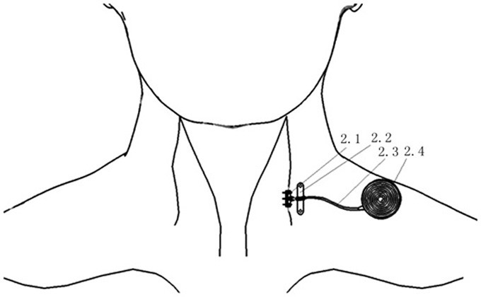 Minimally invasive electrical stimulation system